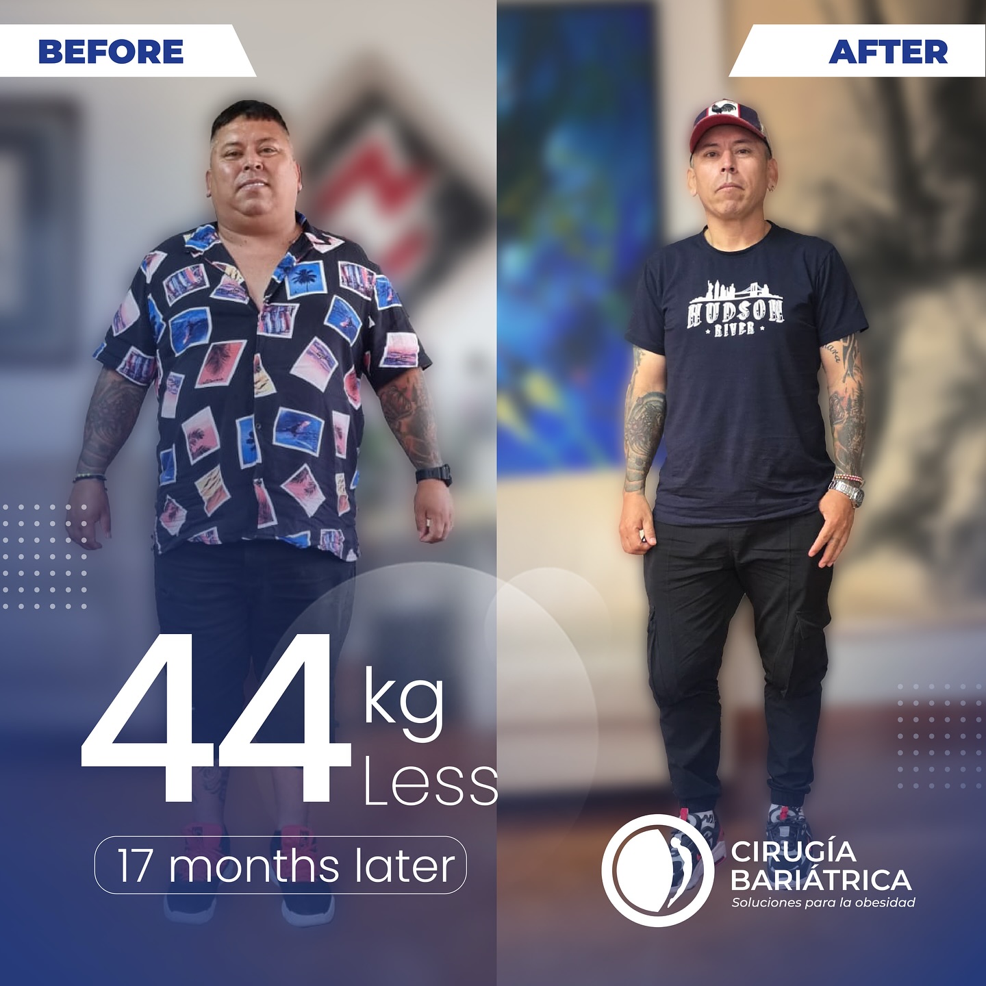 En 17 meses bajó 44 kg gracias a la cirugía bariátrica realizada por el Dr. Bolaños y su equipo. Un cambio guiado por profesionales, con tecnología, precisión y resultados reales. 💙
In just 17 months, they lost 44 kg thanks to the bariatric surgery performed by Dr. Bolaños and his team. A transformation guided by experts, with precision, technology, and real results. 💙
#bariatrica #bariatric #health #healthandwellness #healthyliving #beforeandafter #antesydespues #healthy #weightlosssurgery #weightlossjourney #weightlosstips #salud