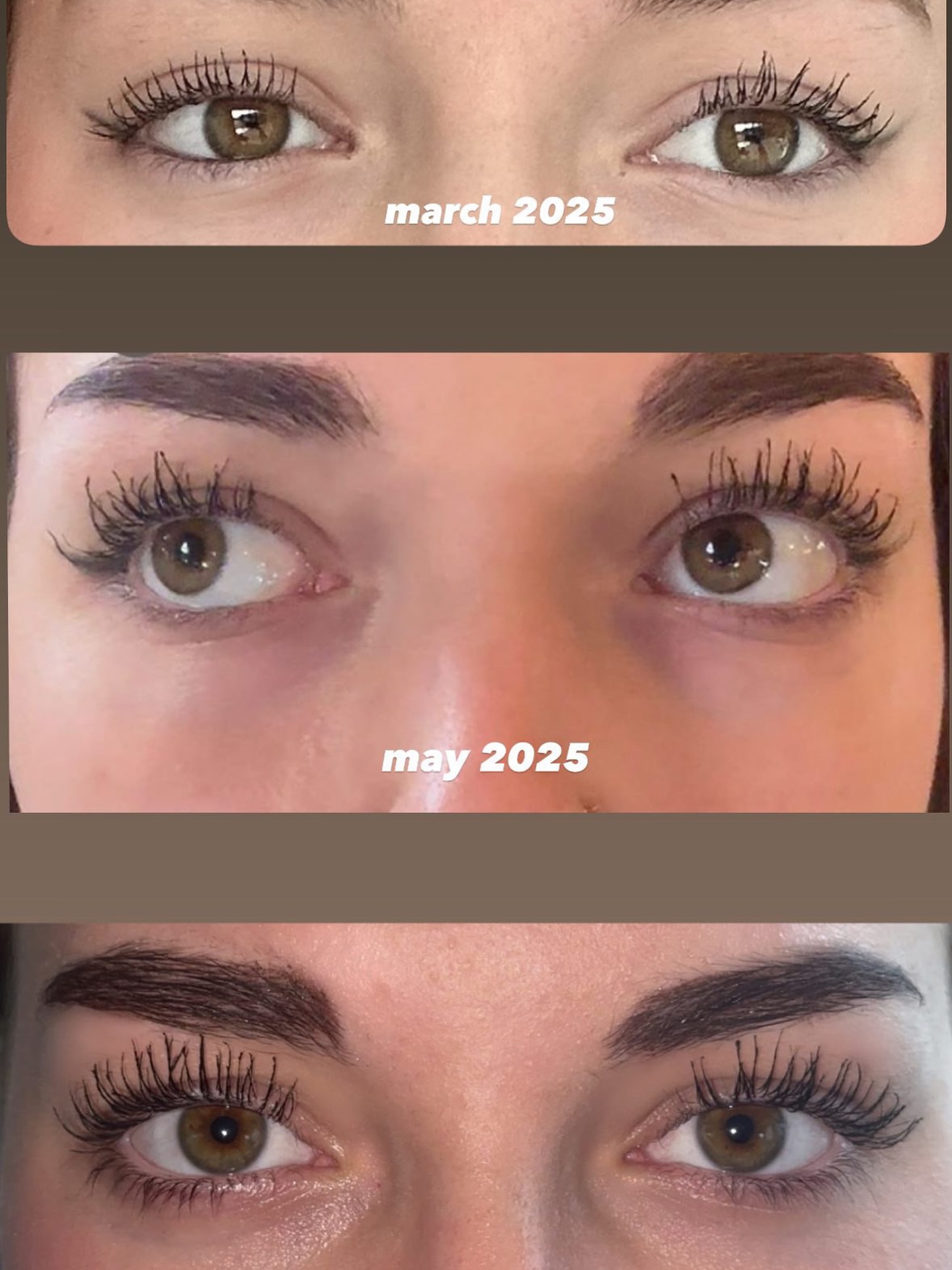 ✨ AURAVIE GLOW SERUMS ✨
No dabīgiem sapņiem līdz satriecošai realitātei – tikai pāris mēnešu laikā!
📅 Rezultāti, kas runā paši par sevi:
➡️ Marts 2025: dabiskas skropstas
➡️ Maijs 2025: redzams garums un apjoms
➡️ Jūlijs 2025: WOW efekts – kuplākas, garākas un izteiksmīgākas skropstas!
💫 Auravie Glow skropstu un uzacu serums:
✔️ Aktivizē dabīgo augšanu
✔️ Stiprina matiņus no saknēm
✔️ Kuplākas, biezākas un izteiksmīgākas skropstas un uzacis