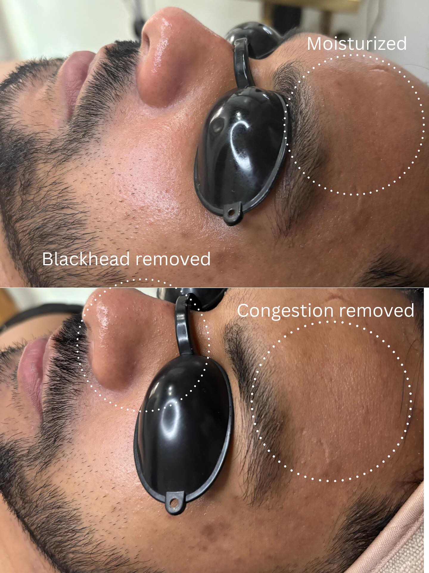 Groom Glow-Up Starts Here 👇✨
Prepping for your big day? Your skin deserves to look as sharp as your suit. Here’s how we get you wedding-ready:
Step 1: Deep cleanse with a salicylic acid peel — clears pores + smooths texture. 🧼✨
Step 2: Brightening enzyme mask targets dullness + hyperpigmentation for that healthy glow. 💡🕊
Step 3: Microneedling treatment helps reduce acne scars + boosts collagen for firmer, clearer skin. 💉🔥
Bonus: Cooling hydro-jelly mask + LED therapy to calm, hydrate, and lock in results. ❄️💙
Whether you’re the groom, best man, or just want to look your best — this is your wedding skin prep game plan. 💍🕺
#MensFacial #WeddingSkinPrep #GroomGlow #Microneedling #BrightSkin #ClearSkinForMen #PasadenaGroom #MensSkinCareRoutine #FacialForMen #GlowUpGroom #pasadenafacial #pasadenahairsalon #pasadenahairstylist #pasadenanailsalon #pasadenanailtech #eyebrowshape #menseyebrows #mensgrooming