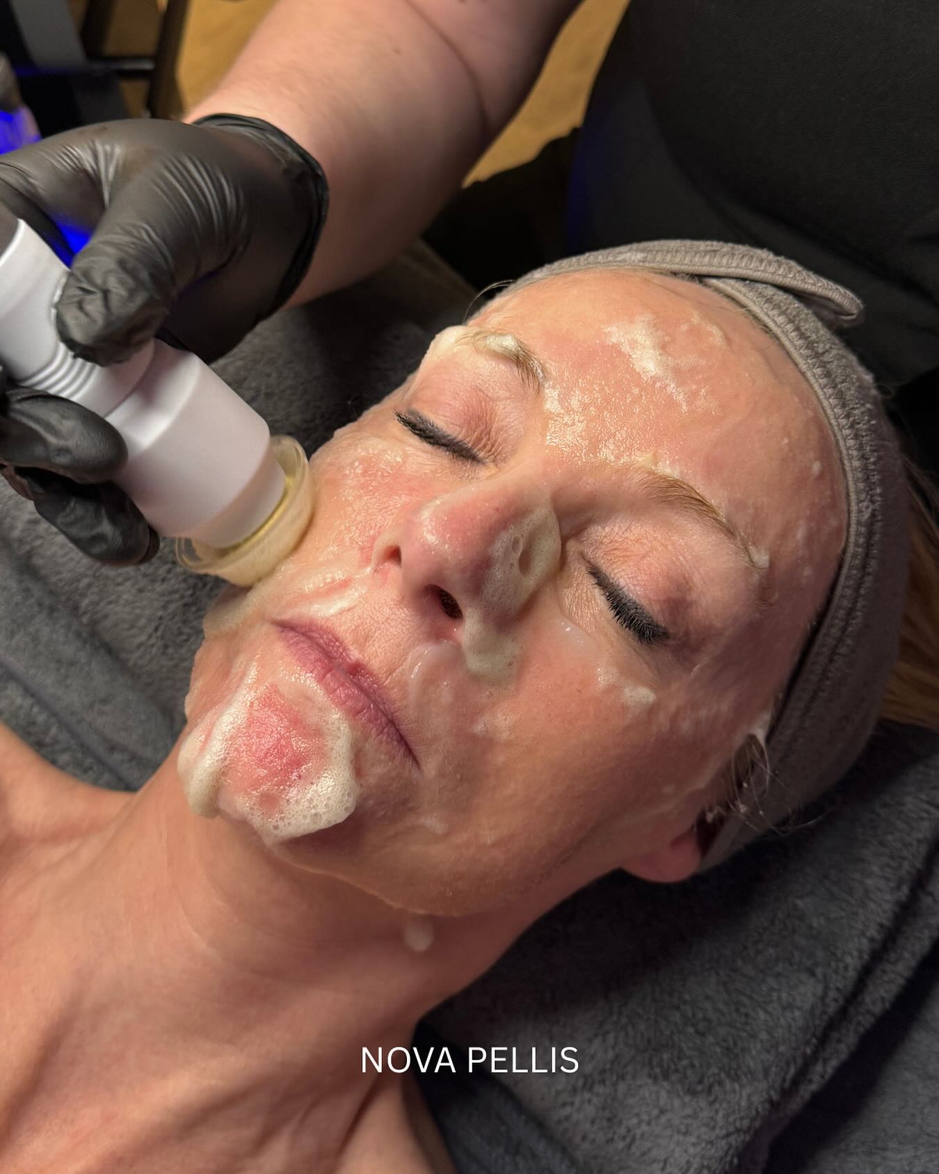 💧Looking to upgrade your facial services?
Our NovaHydra Facial Device is your all in one solution for delivering advanced, results driven skincare in your clinic or salon.
With 10 powerful technologies in one device, NovaHydra combines cleansing, exfoliation, extraction, hydration, and antioxidant infusion in a single 30-minute treatment.
✨Why NovaHydra?
☑️10-in-1 multifunctional system
☑️Perfect for all skin types
☑️Fully customisable to each clients needs
☑️Noticeably brighter, healthier skin after just one session
☑️Encourages repeat bookings and builds client loyalty
Tailor every facial with adjustable intensities, treatment durations, and targeted serums for a truly bespoke experience your clients will love.
📍Book a machine demo or call us today to find out how NovaHydra can transform your treatment menu.
🌐www.novapellisaesthetics.com
💌info@novapellisaesthetics.com
📱0800 009 6397
📱WhatsApp 07497 831533
#novahydra #facial #skin #clinicowners #salonowners #glowingskin #exfoliation #hydratedskin #boostsales #glowup #customfacials #novapellis