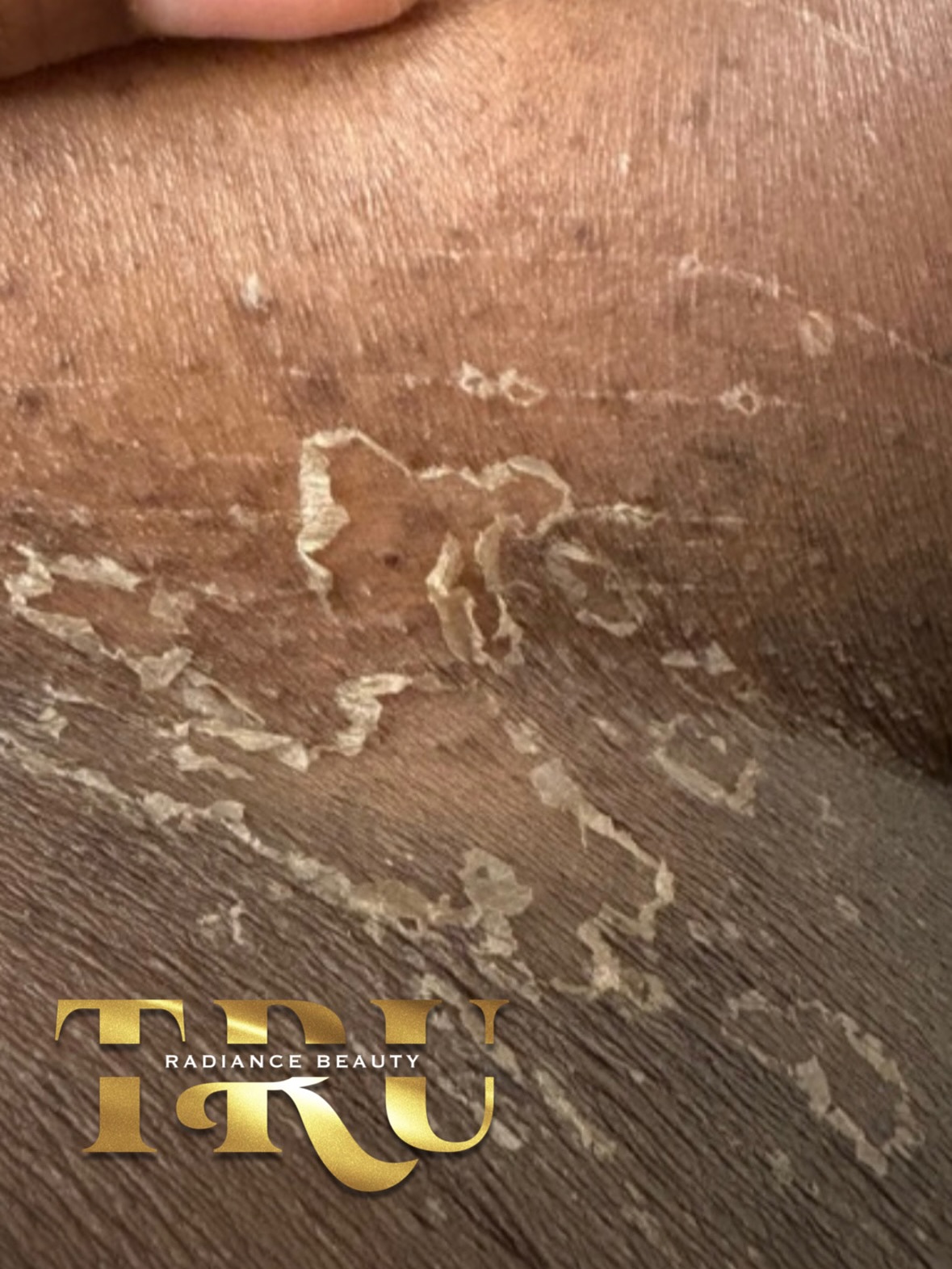 We are 5 days post intimate bleaching and the shedding finally started to get in!
This is her 2nd treatment we can’t wait to see her results this time.
Dont forget, As long as you book your intimate bleaching by aug 1st it is 20% off !
Then it will be back to regular price !
Truradiancebeauty.com
#cincinnatiesthetician #intimatebleaching