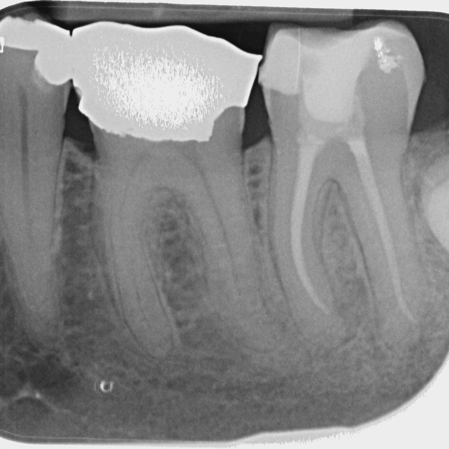 rct ll7 completion and pre op rads. air bubble in the composite- need to agitate the comp more and be 5 seconds more patient before light curing 😒
currently crowned and asymptomatic after 6m
#endodontics #rootcanaltreatment #dentistry #birmingham
#dentist #composite #dental #endo