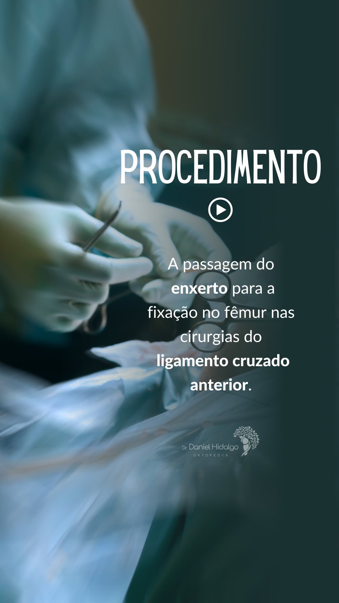 🦵🏻Passagem do enxerto e fixação no túnel ósseo do fêmur nas reconstruções do ligamento cruzado anterior, em que a técnica usada é a fixação femoral com parafuso de interferência. #joelho #ortopedia #ligamentocruzadoanterior
Dr. Daniel Hidalgo - Médico Ortopedista
CRM-SP 137.057 | RQE 41.112
Membro da Sociedade Brasileira de Ortopedia e Traumatologia (SBOT)
Membro da Sociedade Brasileira de Cirurgia do Joelho (SBCJ)