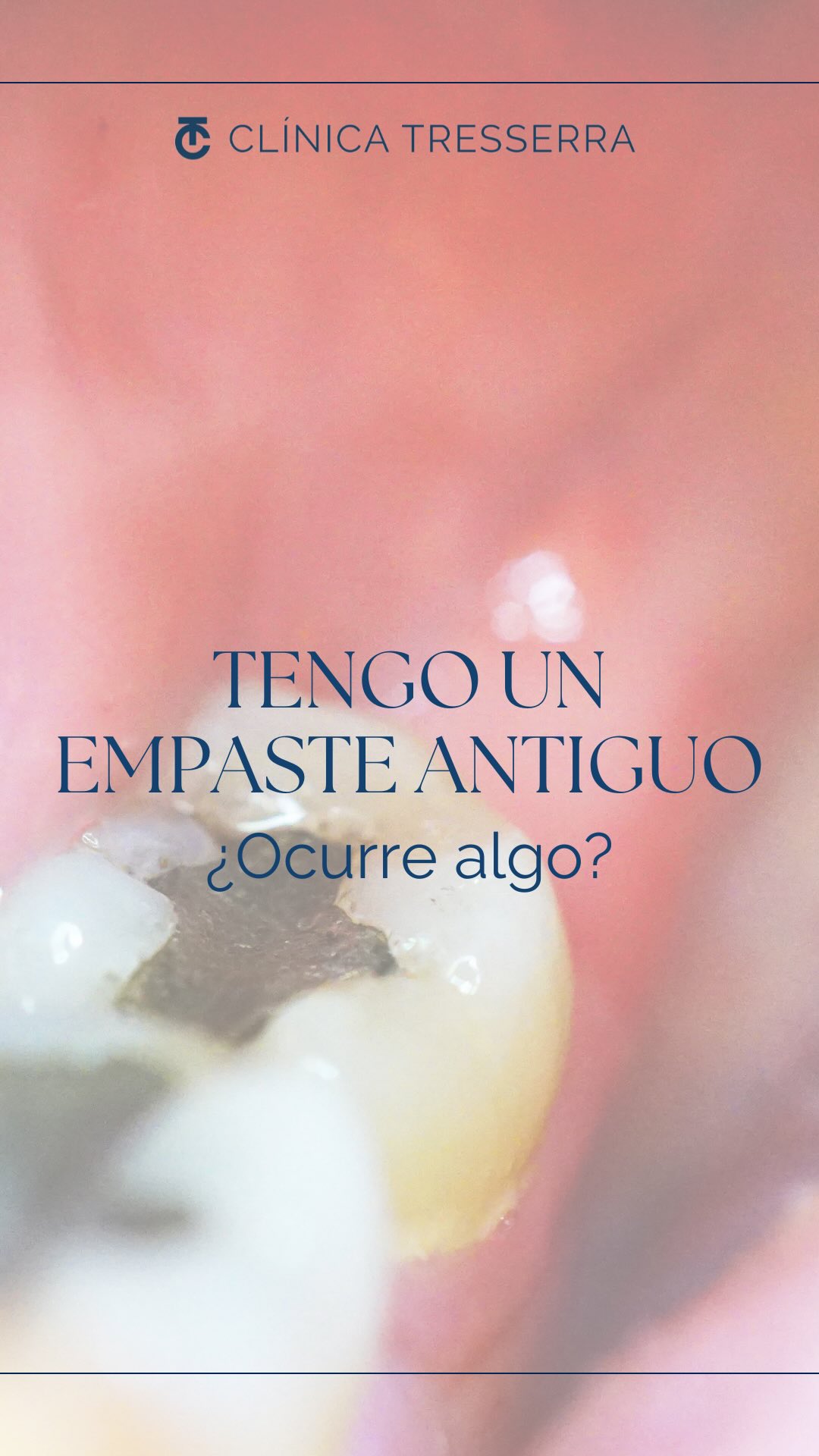 ❓ “Tengo un empaste de hace años… ¿Pasa algo?”
La respuesta rápida: DEPENDE🤷♀️
🦷 Los empastes no duran para siempre y pueden desgastarse, fracturarse o filtrar bacterias.
⏳ Si hace mucho que no lo revisas… ¡es hora de hacerlo!
🔍 Tu boca te agradecerá el control.
#empaste #empastedental #empastedentales #empastesantiguos #clinicadental #dentista