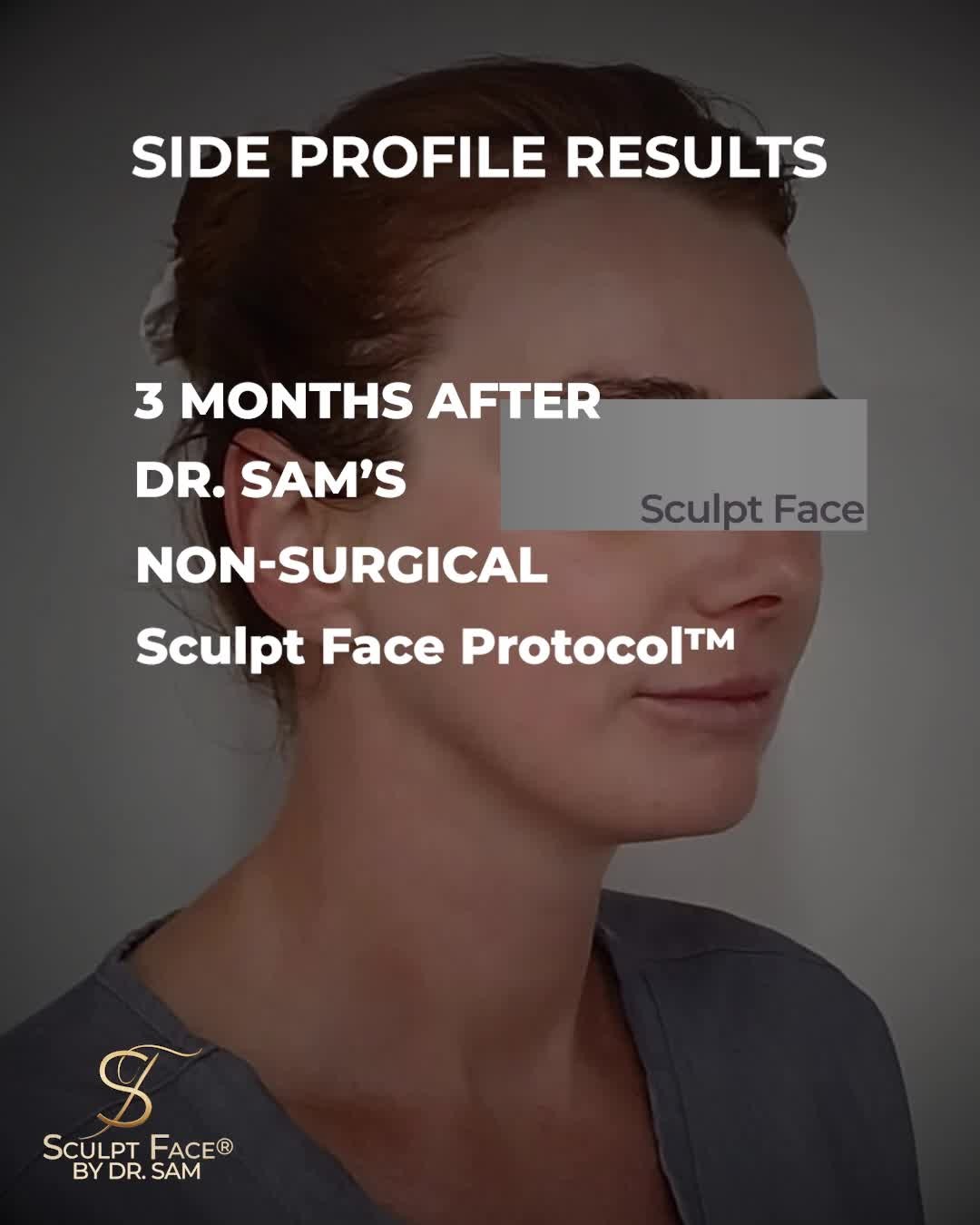 When you care for yourself with intention,
you carry that energy into everything and everyone around you.
This result?
Just one session of Dr. Sam’s Sculpt Face Protocol™.
Three months later, the definition has settled naturally into her features:
🔹 Sharper, more sculpted jawline
🔹 Lifted neck with smoother skin
🔹 Improved side profile without surgery
🔹 No overfilled cheeks
The surgical eye and precision of Dr. Sam bring balance to every feature.
At Sculpt Face®, treatments are tailored for your facial anatomy, skin quality, and long-term beauty.
It's time to elevate your glow.
Discover the Sculpt Face Protocol™, a surgical approach to non-surgical rejuvenation.
By 𝓓𝓻. 𝓢𝓪𝓶 𝔁
#SculptFace
#SculptFaceProtocol
#EndoliftUK
#endolift
#endoliftlaser
#endolifting
#endolifttreatment
#endoliftingfacial
#NonSurgicalFacelifts
#SkinRejuvenation
#SkinGoals
#GlowFromWithin
#CollagenBoost
#SkinTightening
#SkinTighteningTreatment
#facialrejuvenation
#laserrejuvenation
#nonsurgical
#aesthetictreatments
#liverpoolaestheticsclinic
#manchesteraestheticsclinic
#leedsaestheticsclinic
#sheffieldaestheticsclinic
#greatermanchesteraesthetics
#cheshireaestheticsclinic