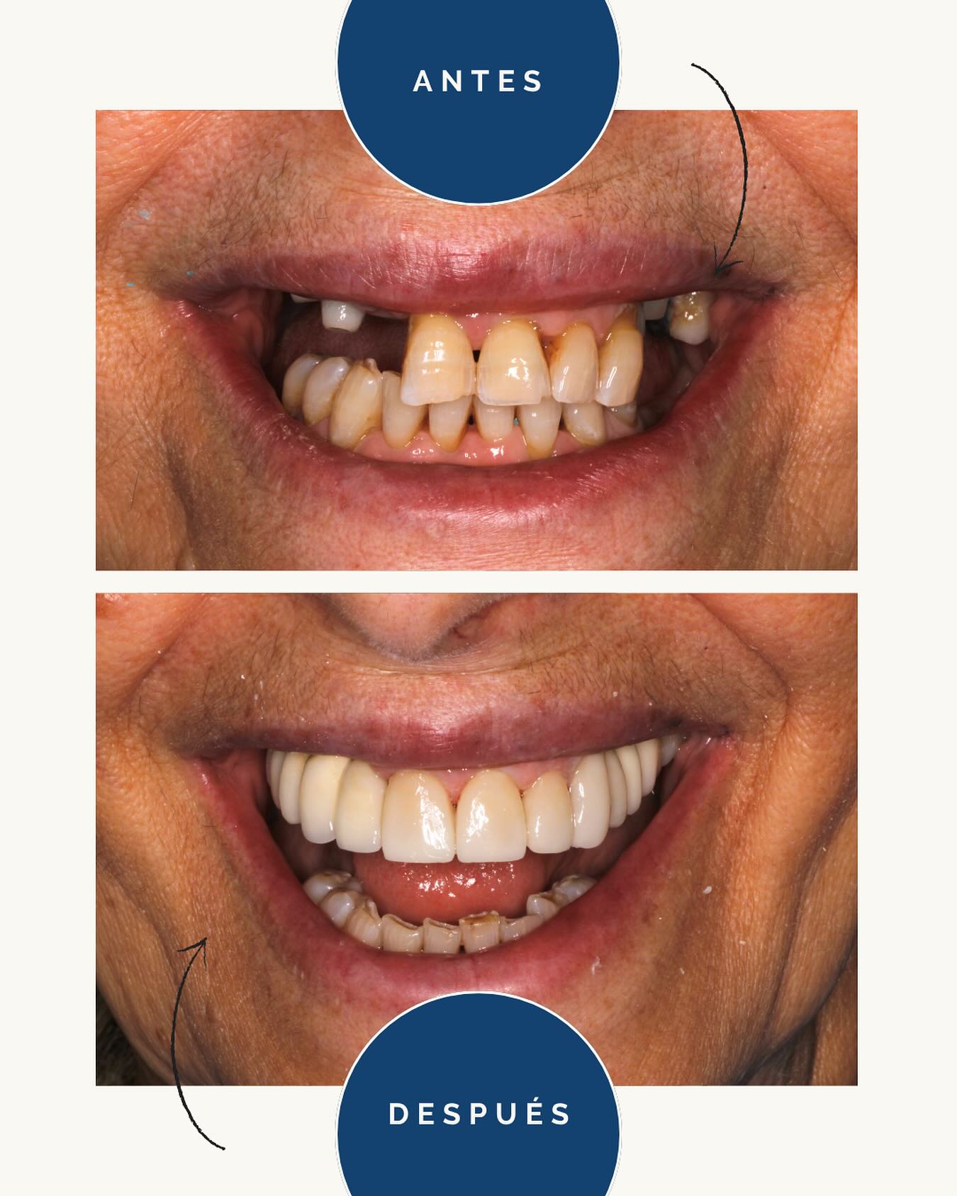 👇ANTES Y DESPUÉS👇
Aquí nos encontramos con un espectacular caso de antes y después 🤗
¿Qué tratamientos creéis que hemos realizado? 🤔
En la arcada superior la paciente había perdido sus molares, por lo que la Dra.Tresserra decidió colocar implantes.
🦷Después de esperar el tiempo de cicatrización, la Dra.Gallart le realizó coronas sobre los implantes y unas carillas en los incisivos para mejorar su sonrisa.
¿Qué te parece el resultado?👩🏻⚕️
A nosotros nos encanta, y la paciente quedó muy contenta con el resultado final 🥰
📩Escríbenos para más información o pide tu cita
#implantes #implantesdentarios #implantesdentales #carillasdentales #carillas #carillasderesina #carillasdeporcelana #carillascomposite #sonrisaperfecta #antesdespues #tratamientodental #tratamientospersonalizados #clinicabucal #clinicadental #clinicadentalbarcelona