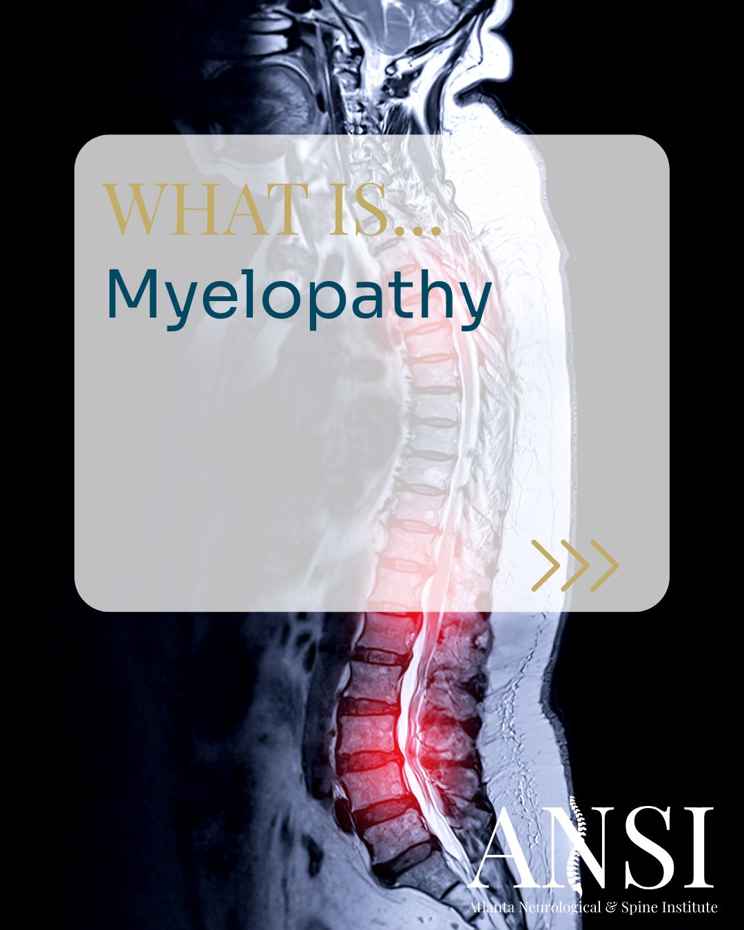 Myelopathy is a spinal cord compression that can lead to numbness, weakness, or coordination issues. Early diagnosis is key to avoiding permanent damage.
.
.
.
#WednesdayWisdom #ANSI #AtlantaSpineExperts