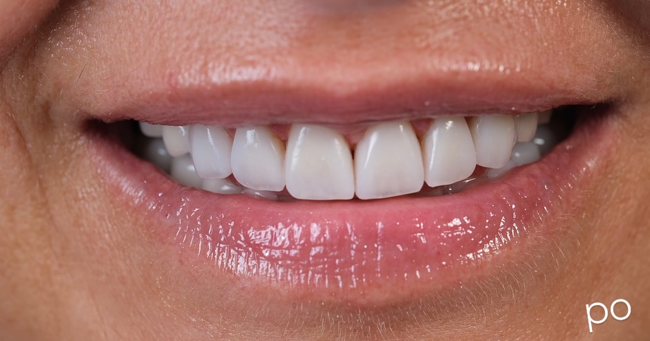 Senas estetinis pakeistas nauju. Nuvalytas senas kompozitas, dengta pilnai , nes reikėjo prailginti nudilusius kandamuosius kraštus.