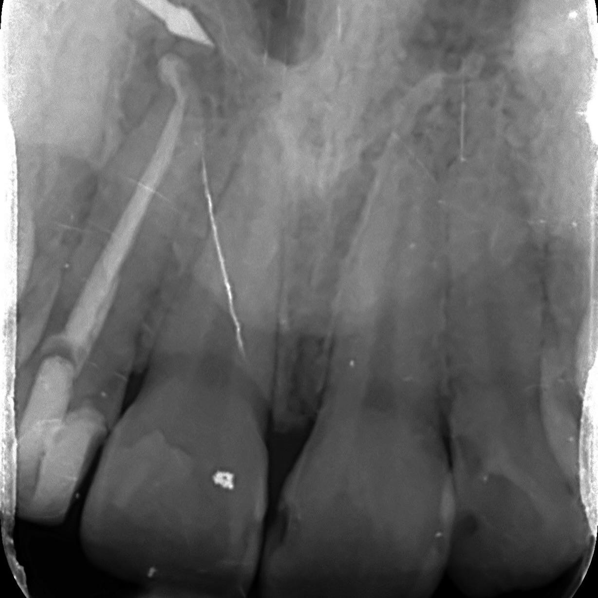 ul2 rct after extirpation by gdp. this 14year old got some strong ohi from me, hopefully no more rcts for her.
I used a wave one gold large file, matching cone with one fil bc sealer
#endo #endodontics #rootcanaltreatment #dentistry #dental #rootcanaltherapy #rct #birmingham
