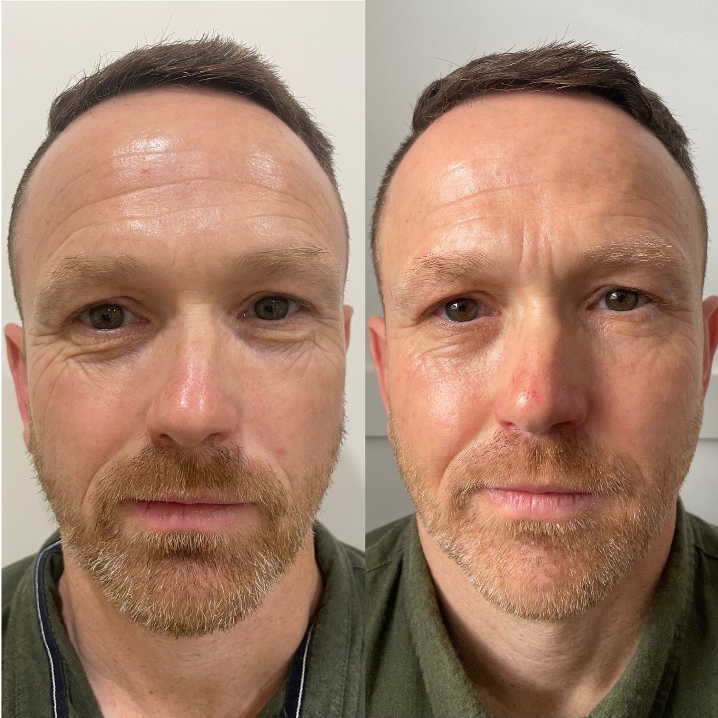 Alma Opus RF Tightening
How amazing are these results, only ONE week post RF skin tightening.
Thank you to our patient for consenting to share.
As you can see there is already an improvement to his crows feet (lines beside his eyes), his forehead lines as well as a more firmer, rejuvenated mid face.
Results will continue to improve with his second treatment around week 8.
If you would like to know more about the RF please comment below or book in for a complimentary consultation with the staff at Bare Beauty Brisbane.
Brighter, better skin is in. Start your journey today.
We have a 20% sale on until the end of August. Jump online and book in and see how the @almalasersau can work wonders for you!
#almaopus #rfskintightening #rf #alma #opus #betterlookingskin #youngerlookingskin #regenerativemedicine #cosmeticclinic #barebeautybrisbane #brisbane #bulimba
