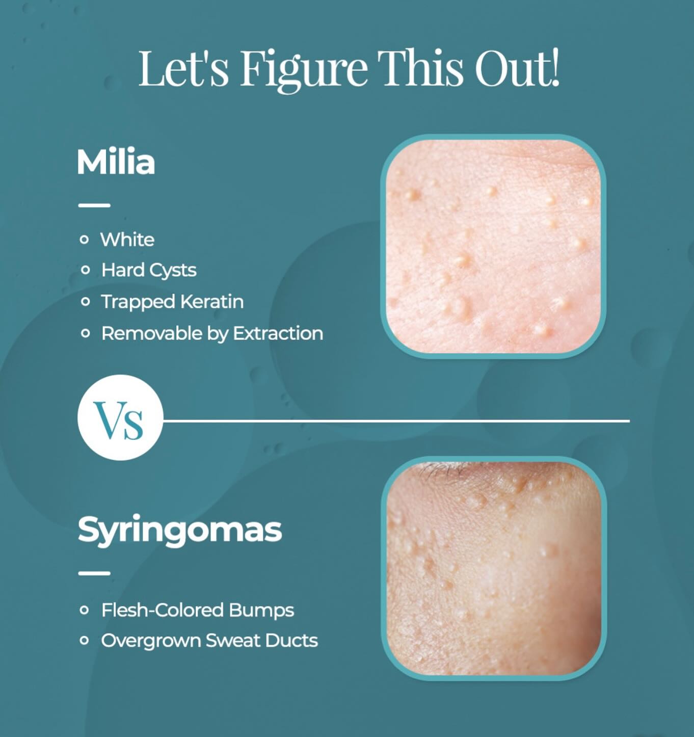 ✅ Milia Prevention Tips:
1. Gentle Exfoliation
• How: Use a mild exfoliant 1–3 times per week.
• Why: Helps prevent buildup of dead skin that can trap keratin.
Examples:
• Enzyme exfoliants (e.g., papaya, pumpkin, pineapple enzymes)
• Use retinol, lactic or mandelic acid
2. Use Non-Comedogenic Products
• Avoid heavy creams, oils, and makeup that can clog pores—especially around the eyes.
3. Proper Cleansing
• Clean your face thoroughly, especially at night, to remove sunscreen, makeup, and pollution that can contribute to clogged pores.
4. Hydrate Smartly
• Choose lightweight, hydrating products like gel moisturizers or serums with hyaluronic acid.
• Avoid overly occlusive eye creams unless your skin is very dry.
5. Sun Protection
• UV damage can thicken the outer skin layer, increasing risk of milia.
• Use broad-spectrum SPF 30+ daily.
6. Avoid Heavy Occlusives Around the Eyes
• Petroleum jelly, thick balms, or heavy creams near the eye area can trap keratin under delicate skin.
7. Professional Facials
• Monthly or seasonal facials with gentle exfoliation and proper extractions can help prevent buildup.
• Techniques like enzyme masks, ultrasonic exfoliation, or light chemical peels can be very effective.
⸻
Bonus Tip (Holistic Approach):
• Diet: Anti-inflammatory foods rich in antioxidants (berries, green tea, leafy greens) can support healthy skin turnover.