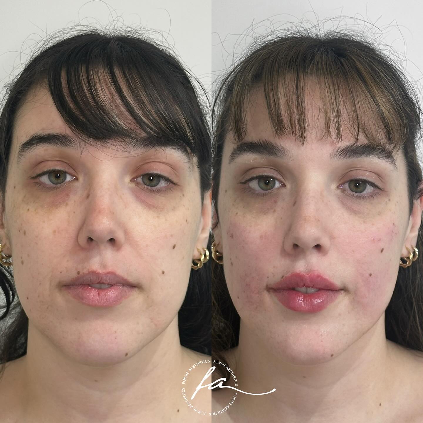 Gradual, balanced restoration of facial volume to support natural contours. Adjustments made to the mid-face and lower third to enhance symmetry and gently refresh overall appearance.
📍Forme Aesthetics – Doncaster East
🖥 Appointments via www.formeaesthetics.com
📸 Images shared with consent
—
Stephanie Sirillas, Registered Nurse
Cosmetic Nurse Injector | AHPRA No. NMW0001907789
All medical treatments carry risks. A thorough consultation is required to assess suitability.