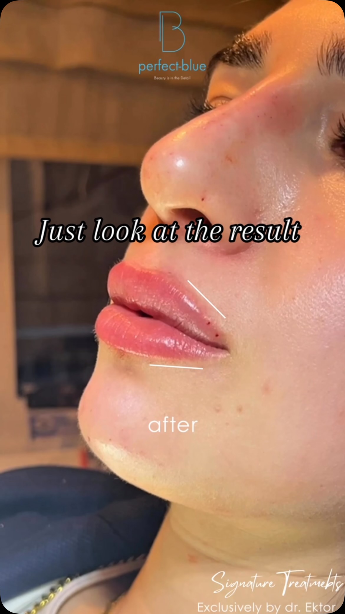 Just look at the result 👀
The lips you dream of👄 ✨
Signature Treatment
Exclusively by @dr.ektor
✨ Only @dr.ektor
📲 Book your appointment:
📞 GR: +30 210 725 8982
📞 CY: +357 96 444 870
📧 info@perfect-blue.com
🌐 www.dr-ektor.com
#DermaHyppp #AcneScars #SkinTransformation #NoMoreFilters #SmoothSkinJourney #ConfidenceInYourSkin #DrEktor #SignatureProtocol #PremiumSkinCare #Kolonaki #Limassol #Greece #Cyprus #GlowingSkin #SkinGoals #lip #lipsaugmentation #kolonaki #athens #cyprus #drektor #fyp #foryou #reelsviral #beautiful #viral #splashcreativehub #sommerdeals