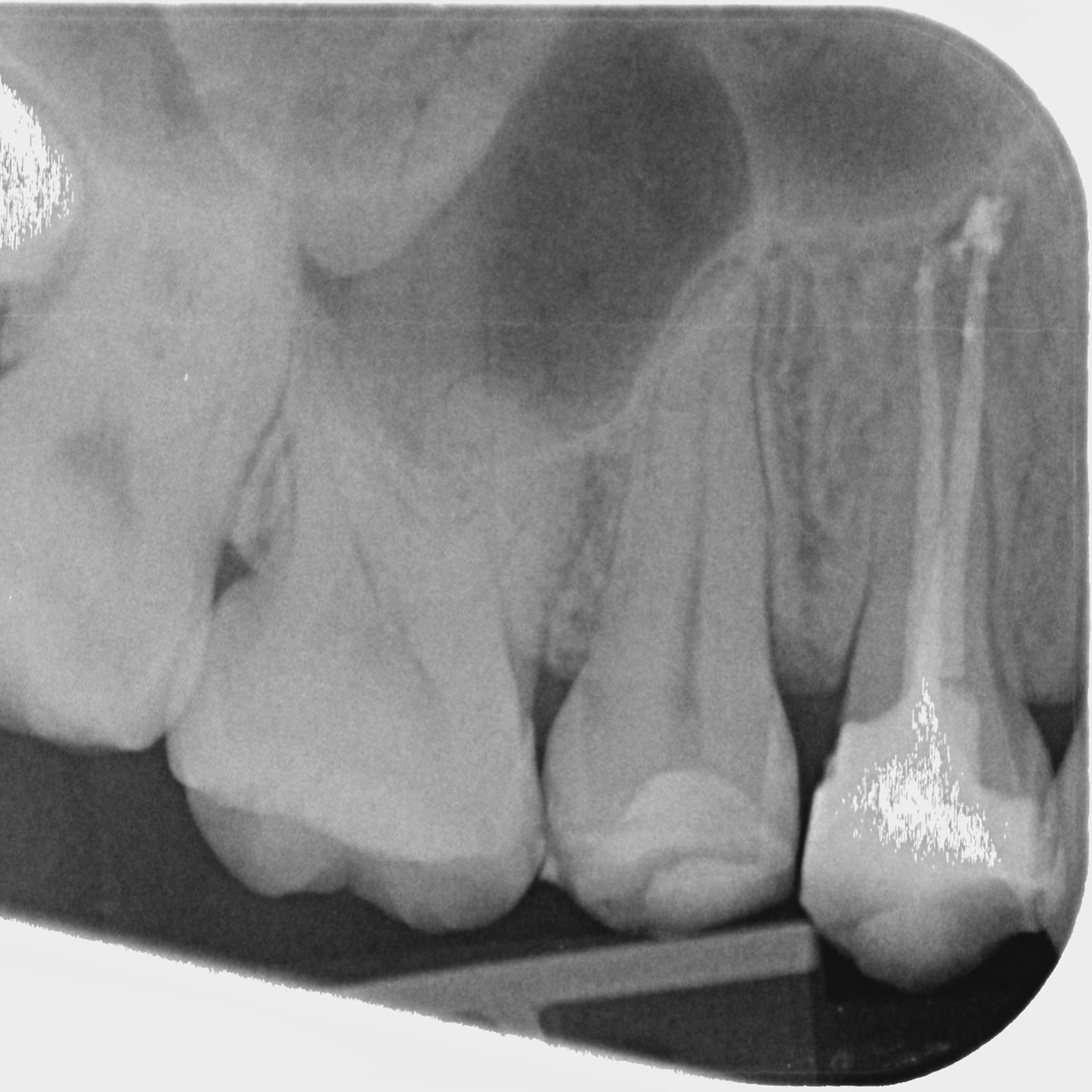 patient attended with pain when biting on ur4, 2 years after primary rct. no cracks detected but found mesial caries leaking into the composite. retreated in 60 mins
#endo #rct #rootcanaltreatment #endodontics #dentistry #teeth #rootcanaltherapy #birmingham