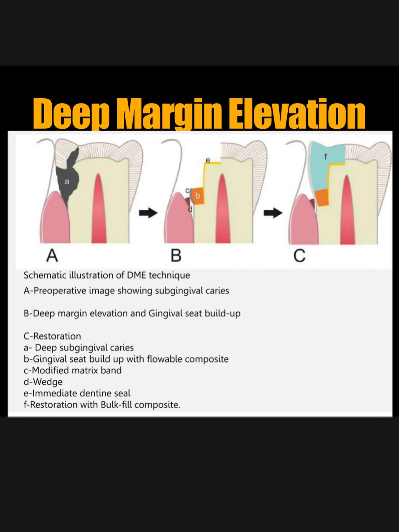 Deep Margin Elevation (DME). A quick summary. #nhs #treat #treatment #endowarrior #endodontia #rootcanaltreatment #rootcanaltherapy #endobelly #waves #waveonegold #saveteeth #endospecialist #treatyourself #simplicity #dentaltreatment #compositebonding #dentistry #endodontics #dentaltreatment #difficultendo #dentistrylife #dentistrylove #dentallife #oralhealth #veneers #dentalhygiene #healthysmile #dentalhealth #deepmarginelevation #dme