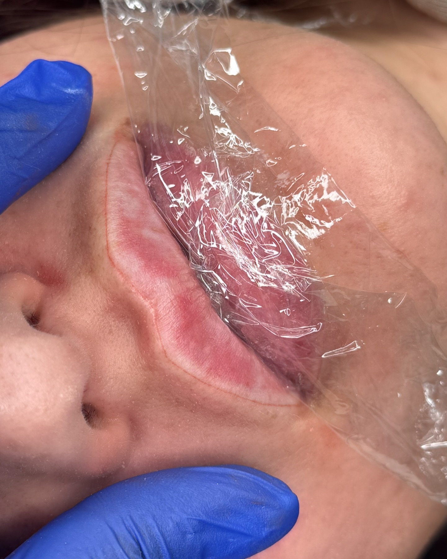 โจ Starting our ombre lip blush journey with crisp, flawless outlines to give the lips perfect definition. ๐
Before we begin, a numbing cream is applied to make sure my client is super comfortable and painโfree throughout the treatment.
๐ Ombre lip blush is all about creating soft, naturalโlooking colour with a beautifully defined border that heals into a subtle tint.
Would you try lip blush? Comment below! ๐
#OmbreLipBlush #LipBlushUK #PermanentMakeupUK #PMUArtistUK #lipblush #LipBlushBristol #LipBlushSpecialist #LipBlushBeforeAndAfter #UKPMUArtist #LipBlushTransformation #LipBlushTreatment #BeautyTechUK #PMUTrainingUK #ViralBeautyTrends #LipBlushHealing #LipTattooUK #OmbreLipsUK #UKBeautyIndustry #foryou #fyp