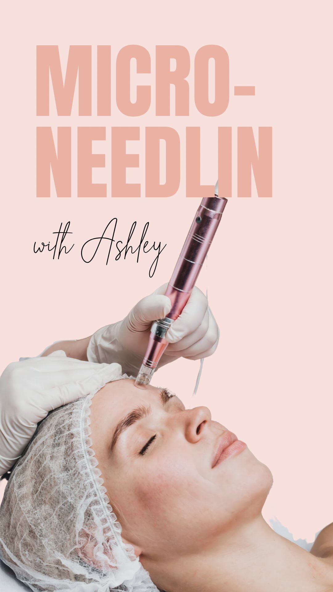 Microneedling is clinically proven to stimulate collagen!!
It creates controlled micro-injuries that trigger your skin’s natural healing response. This stimulates fibroblasts, boosting collagen and elastin production — the proteins responsible for firmness, bounce, and elasticity.
📚 Studies show up to a 400% increase in collagen after multiple sessions.
Here’s why this collagen-boosting treatment is worth the hype 👇
-Stimulates collagen + elastin production
-Softens fine lines + wrinkles
-Improves skin texture + tone
-Targets acne scars + pigmentation
-Refines pores
-Strengthens the skin barrier
-Enhances product absorption
-Gives skin a plump, youthful glow
-Suitable for most skin types
-Long-term results with minimal downtime
Ready to get glowing?
#Microneedling #SkinGoals #CollagenInductionTherapy #GlowUp #SkinJourney #pHformula #RoseLoungeSkin #Somersetwest