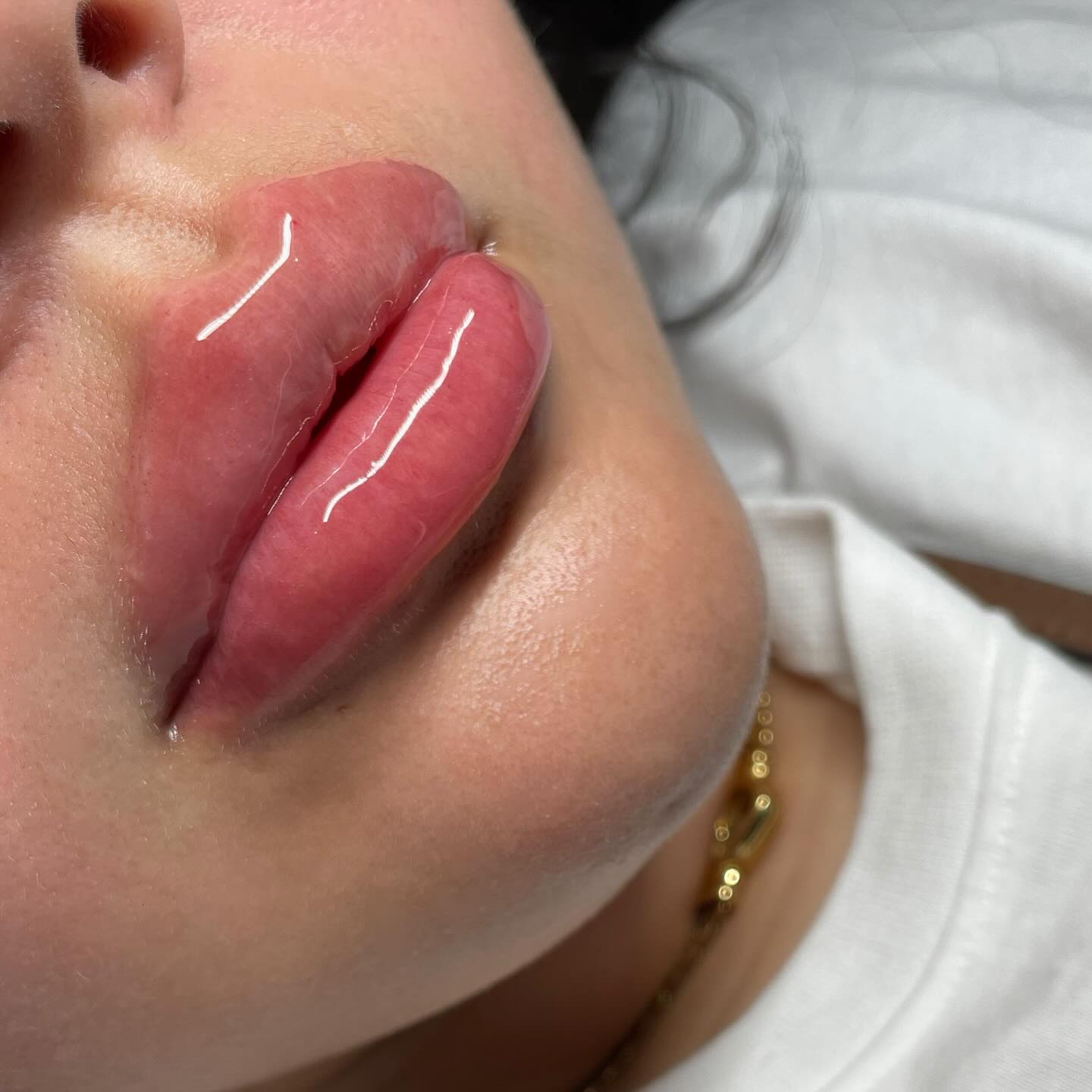 Lips to the Gods ๐๐พ๐ 2.5mL injected total. $250 per syringe. Get in where you fit in ๐ซถ๐ฝ #tampalipsfiller #lipfiller #lipinjections #bradentonlipfiller #fillers #sarsotalipfiller #lipfillerclass