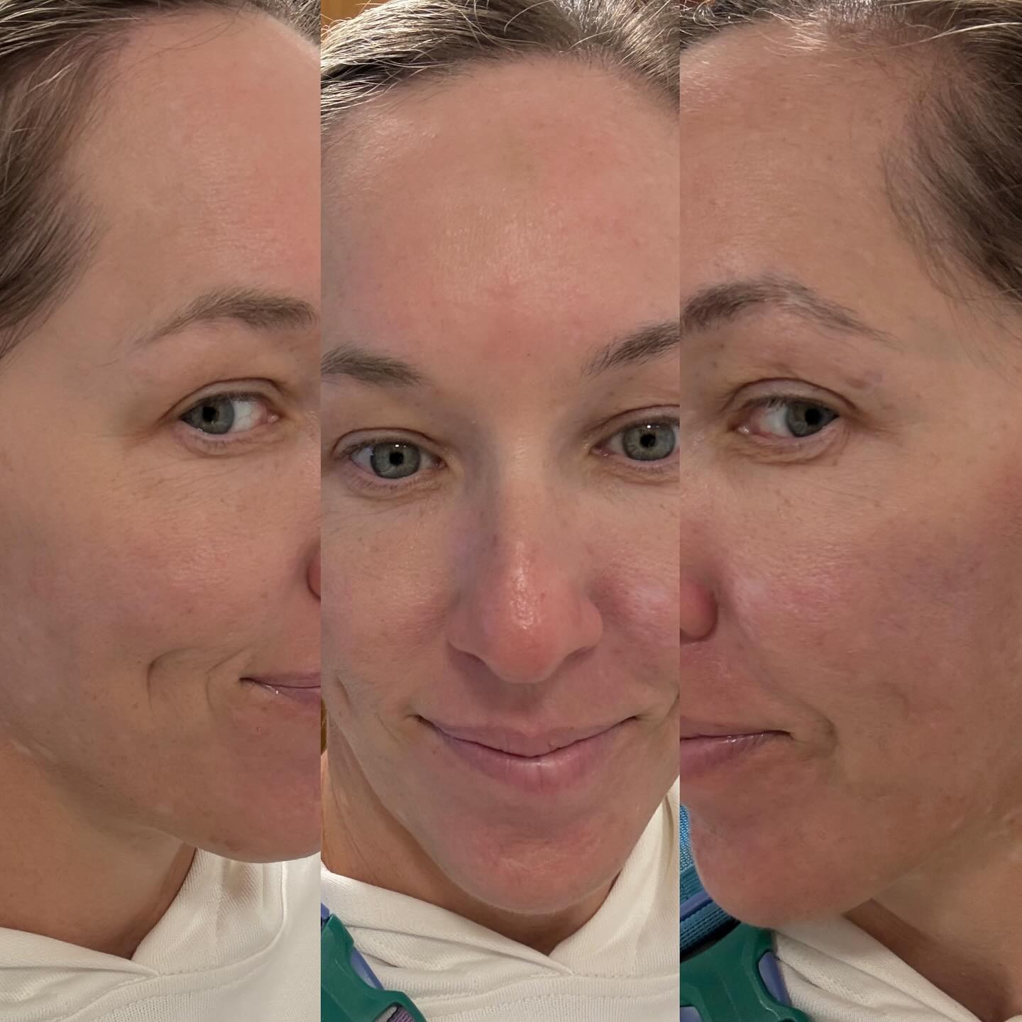 📸 “Caught a glimpse in the mirror and had to snap these real quick…”
(Bruise still slightly present on my forehead from injecting myself a week ago…so it’s clearly an authentic no make up pic 😂🤪)
Two weeks post-microneedling and WOW — this wasn’t planned, but when you see your bare, makeup-free skin glowing, you pause.
I had totally baked my face in the Bahamas (thanks, island sun ☀️), and I honestly thought recovery would take forever. But here I am — two weeks later — feeling like my skin is back on track and better than ever.
✨ My post-treatment MVPs:
— Exosomes from @invoaesthetics
— Salmon sperm from @mdpen
— And the real star: Rejuvenating Complex from @invoaesthetics (if you know, you know)
This combo brought the bounce, brightness, and clarity back FAST.
📍Microneedling done at my studio — and yes, I’ll be doing this protocol again and again.
**skin slightly pink because it’s 60 degrees here and I’m cold 🥶
#microneedling
#mdpen
@erin_invoaesthetics
@invoaesthetics