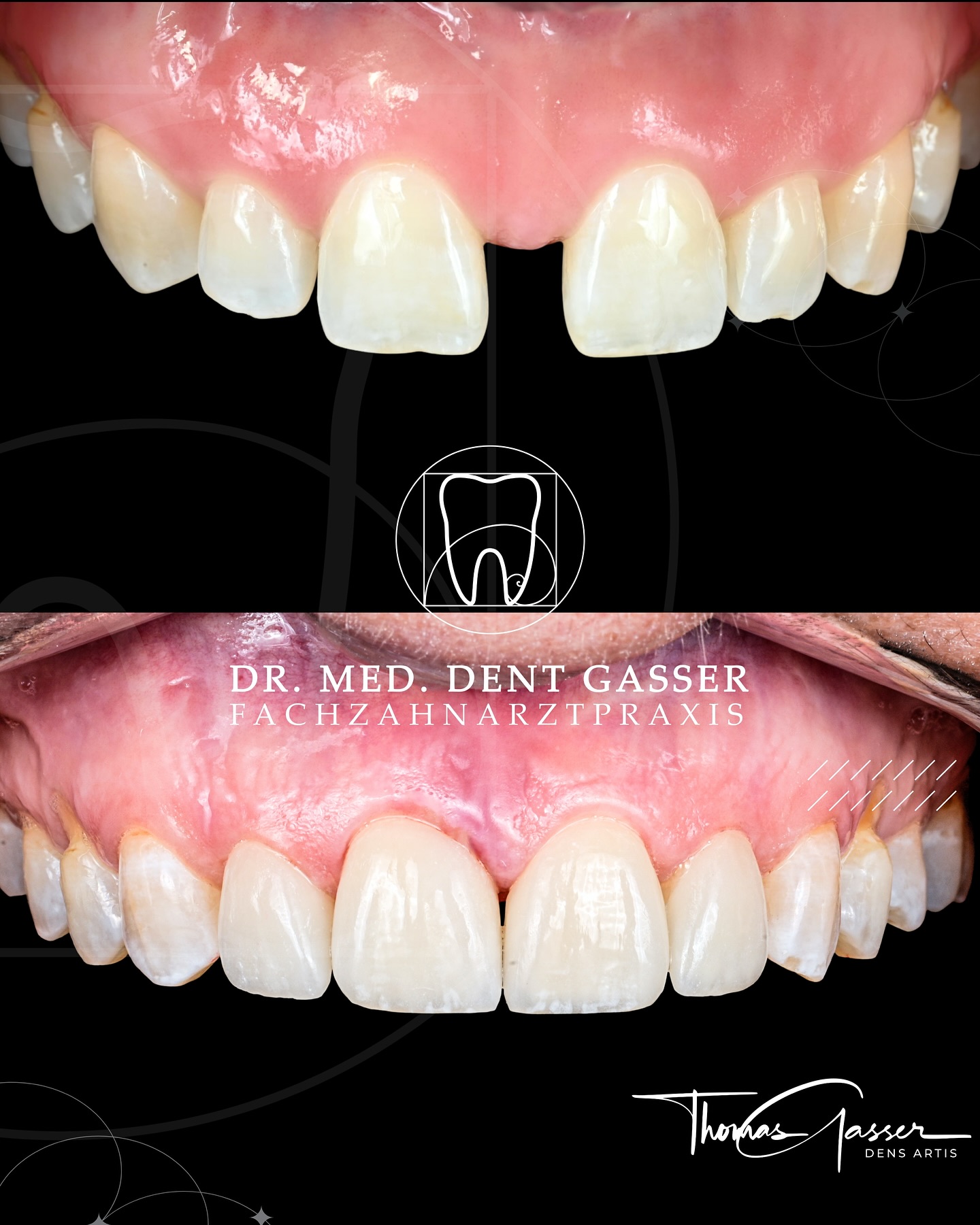 🦷 Veneers neu gedacht: Makellose Ästhetik und maximaler Zahnerhalt
Kleine Makel an den Frontzähnen können Ihr Lächeln oft mehr beeinflussen, als Sie denken. Mit Veneers lassen sich Form, Farbe und Stellung schonend korrigieren – für ein harmonisches, selbstbewusstes Auftreten.
➡️ Nach einer präzisen Planung werden hauchdünne Keramikschalen individuell gefertigt und auf die Zahnoberfläche aufgebracht.
➡️ Die Behandlung ist minimalinvasiv und sorgt für ein natürlich wirkendes Ergebnis, das viele Jahre Freude schenkt.
💡 Vorteile moderner Veneers:
✔️ Perfekte Ästhetik bei minimaler Zahnpräparation
✔️ Langanhaltend und verfärbungsresistent – Farbe und Form bleiben dauerhaft stabil, anders als bei Bleaching oder Füllungen
✔️ Schließen kleiner Lücken und Risse
✔️ Schonende Behandlung ohne große Eingriffe
✔️ Individuell gestaltete Form und Farbwirkung
⚠️ Nicht jede Zahnsituation eignet sich gleichermaßen – wir beraten Sie transparent, ob Veneers die richtige Lösung für Sie sind.
Veneers sind heute viel mehr als nur ein „Schönheits-Upgrade“ – sie sind ein innovatives Konzept für natürliche Ästhetik und Lebensqualität.
📍 Fachzahnarztpraxis Dr. Thomas Gasser
Greifengasse 1, 4058 Basel
📞 +41 61 681 00 10
📧 fachzahnarztpraxis_basel@sso-hin.ch
🌐 www.densartis.ch
#Veneers #Zahnästhetik #SchöneZähne #ÄsthetischeZahnmedizin #ZahnarztBasel #Basel #BaselSchweiz #Minimalinvasiv #Zahnerhalt #PerfektesLächeln #DrThomasGasser #BaslerZahnarzt #ZahnmedizinMitHerz