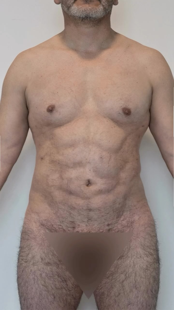 En esta ocasión queremos mostrarles un resultado increíble de lipomarcación abdominal en un paciente, ¡a solo un mes de la cirugía!
Quiero aclarar algunos puntos importantes:
* Resultados y tiempo: Las marcas y la definición que ves hoy se atenuarán ligeramente con el tiempo. El resultado final se asienta a medida que el cuerpo se desinflama por completo, revelando un abdomen natural y esculpido.
* Diseño personalizado: Cada cuerpo es único. Las marcas que realizo no son un patrón preestablecido; se diseñan cuidadosamente siguiendo la anatomía muscular de cada paciente para un resultado auténtico y personalizado.
* Mantenimiento: ¡El trabajo no termina aquí! La lipomarcación realza tus músculos, pero tú eres el motor del cambio. Si mantienes una rutina de ejercicio y una alimentación saludable, tus músculos crecerán y se verán exactamente como los definimos en la cirugía, pero con tu propio volumen.
Si tienes más preguntas, déjalas en los comentarios. 👇