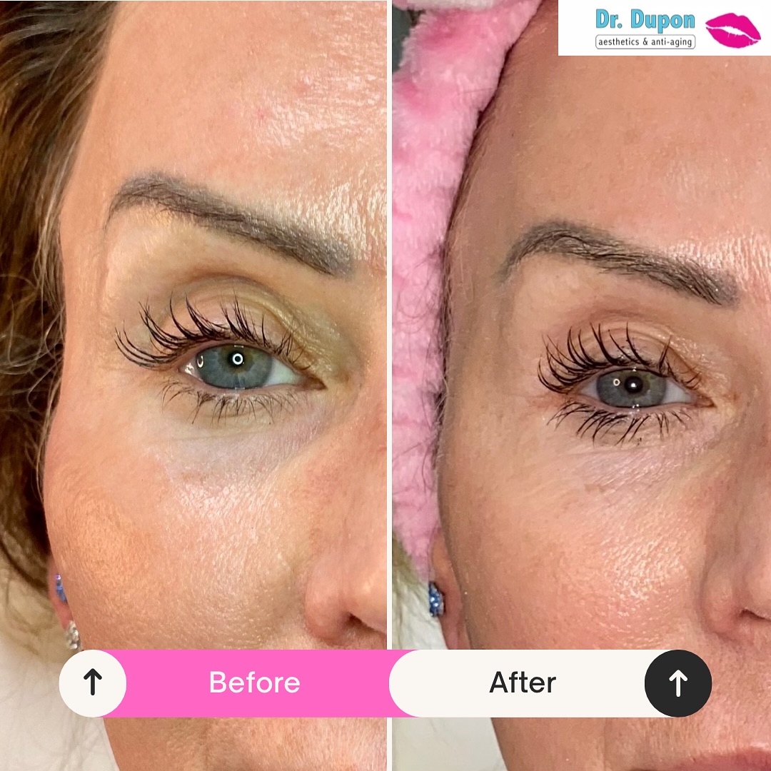 ✨ Temple Filler with Radiesse + Belotero ✨
Restore volume and contour with long-lasting results!
💰 $900
⏰ Just 15 minutes
❤️🩹 Recovery: 1–3 days
😱 Minimal discomfort
📆 Lasts 2–3 years
Book your appointment with Dr. Dupon today!!
www.drdupon.com | 📞 Call or DM now