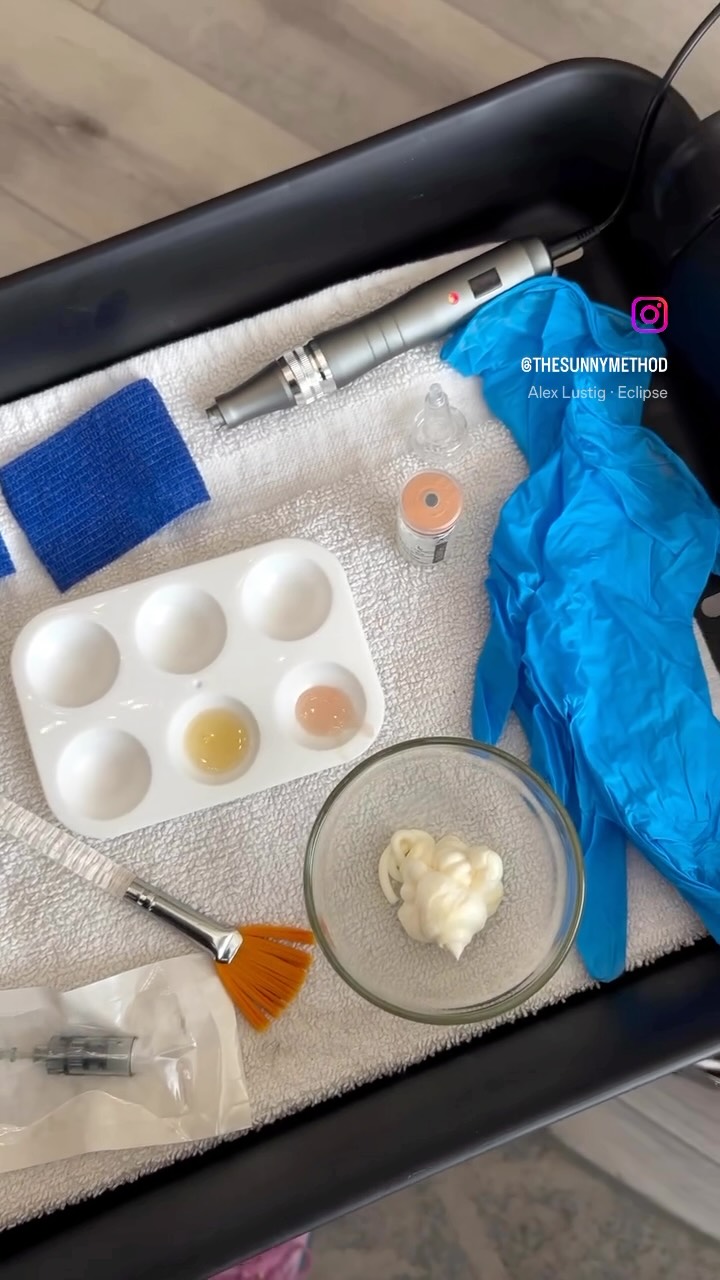 Microneedling is used to treat a variety of skin conditions that cause depressions in the skin such as ache scarring, surgical scars, other scars, burns, enlarged pores, wrinkles, and stretch marks.