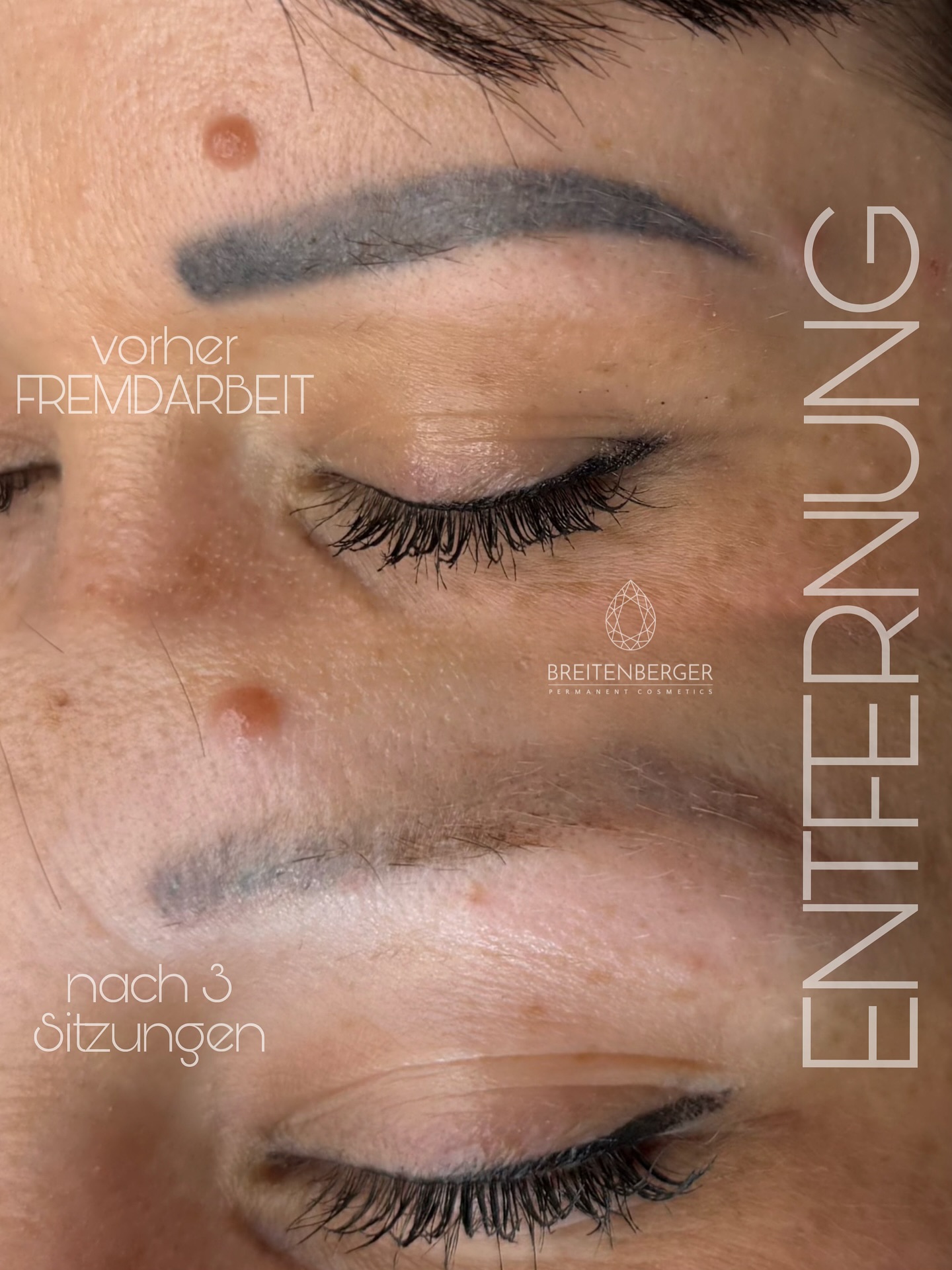 🚫 Von unschönem Microblading zur alten Frische✨
Diese Kundin hatte über die Jahre mehrfach Microblading machen lassen, offensichtlich wurde hier leider gepfuscht – dadurch ist die Haut an manchen Stellen leider vernarbt. Man sieht deutlich: wo extrem viel und zu tief pigmentiert wurde, braucht es natürlich auch mehr Sitzungen, bis die Farbe komplett verschwindet.
Trotzdem: es lohnt sich 💪🏼 – Schritt für Schritt wird die Pigmentierung deutlich heller, und nach der Entfernung hast du keine Ausfallzeit. Du bist sofort wieder alltagstauglich 🙌🏼
Mit etwas Geduld schaffen wir den Weg zurück zu natürlichen, feinen Brauen – ohne Balken, ohne Grauschleier, sondern mit neuer Leichtigkeit ✨
PMU ENTFERNUNG
PMU REMOVAL