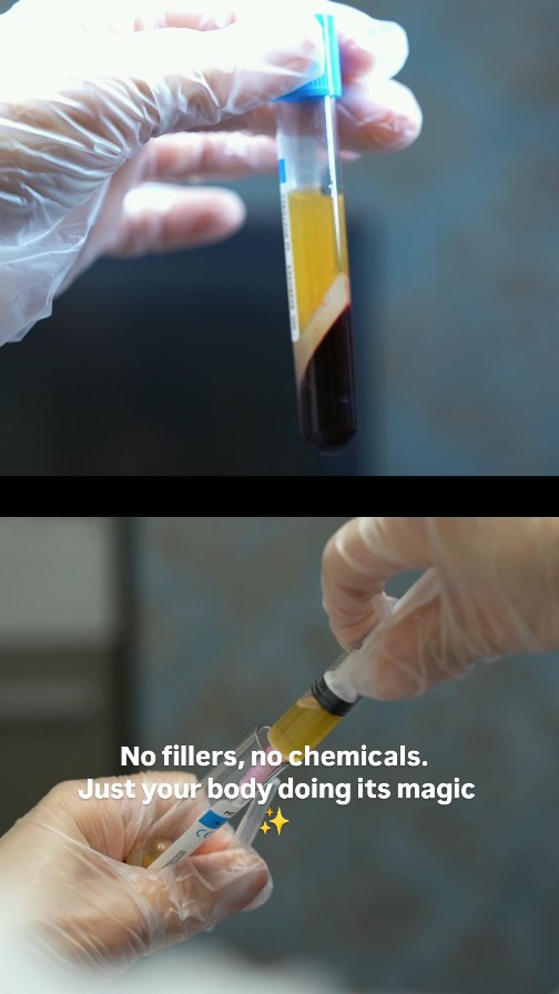 💥 Now only $350 — limited time!
💉 No fillers. No chemicals. Just results.
🩸✨ PRP Facial — Your skin’s natural superpower!
This advanced treatment uses your own plasma to:
✔️ Boost collagen
✔️ Improve texture & tone
✔️ Fade acne scars & pigmentation
✔️ Brighten and tighten skin
Clients love it for the glow that lasts. 💫
💬 DM to book or ask questions!
📍LNO Boutique | Highlands Ranch, CO
Filming by beautiful @lily.filmmaker 🪄🤩
#PRPFacial #GlowingSkin #SkincareClinic #AcneScarTreatment #MicroneedlingWithPRP #DenverEsthetician #LNOCare#HighlandsRanchSpa
#DenverFacial
#ColoradoEsthetician
#LNOcare
#DenverSkincare
#ColoradoBeauty
#SpaHighlandsRanch
#HighlandsRanchBeauty
#SkincareColorado
#DenverWellness
#BeautyDeals
#SpaSpecial
#FacialOffer
#SkincareSale
#LimitedTimeOffer
#SpecialPrice
#GlowForLess
#SkincarePromo
#BeautyOnABudget
#PRPDeal
#lno_boutique