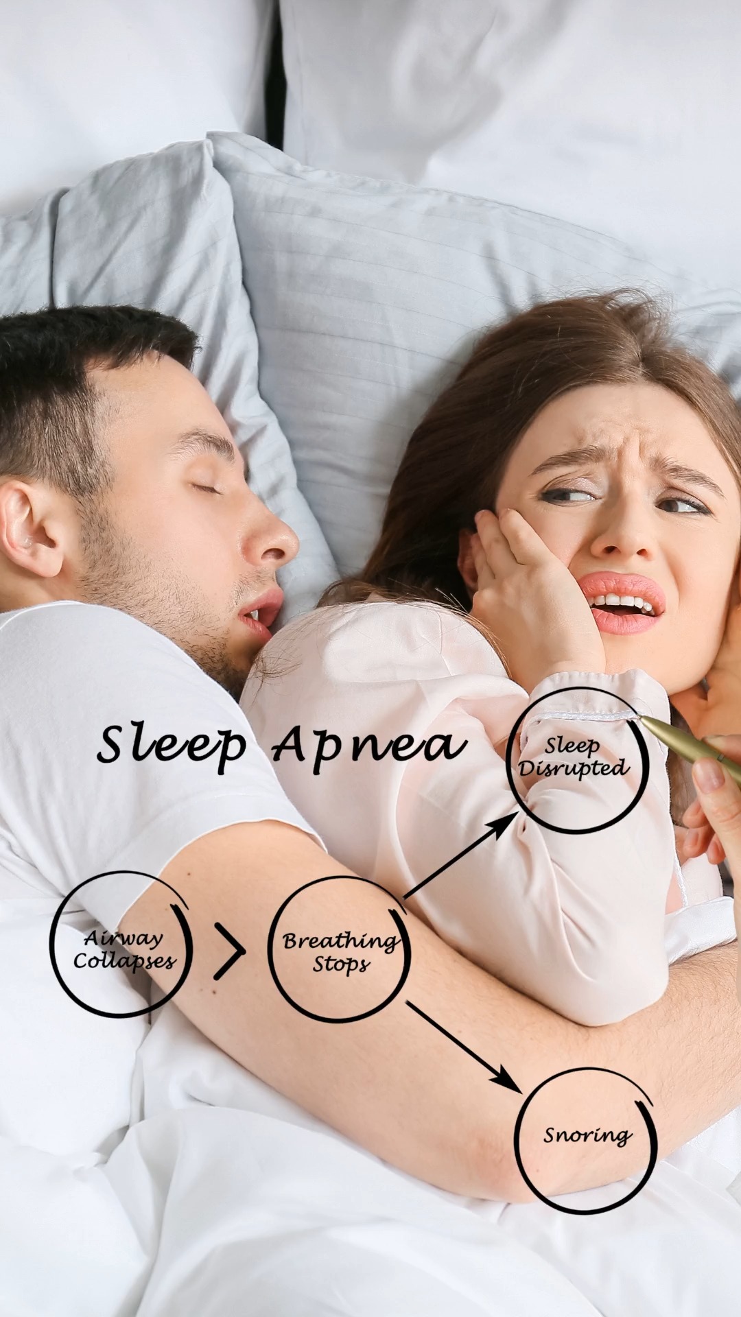 Your Sleep Is Destroying Your Kidneys
WHAT MOST PEOPLE DON'T KNOW:
Poor sleep doesn't just make you tired—it's silently destroying your kidney function.
THE SHOCKING RESEARCH:
📊 5-year study (4,200 adults) - Journal of American Society of Nephrology:
Each hour of lost sleep = 1.19x increased risk of rapid kidney function decline
📊 Massive 11-year study (432,000 people):
Poor sleep quality increased chronic kidney disease risk by 40%
SLEEP APNEA: THE SILENT KILLER
2020 meta-analysis (3+ million participants) - American Journal of Kidney Diseases:
Untreated sleep apnea raises CKD risk by 20-30%
WARNING SIGNS YOU NEED A SLEEP STUDY:
⚠️ Loud snoring your partner complains about
⚠️ Witnessed breathing stops during sleep
⚠️ Excessive daytime fatigue despite "enough" sleep
THE BOTTOM LINE: A sleep evaluation could be absolutely life-saving for your kidneys.
SAVE THIS POST if you found it helpful and SHARE with someone who snores loudly.
📚 References:
Sleep Duration and Kidney Function Decline:
Muntner, P., et al. (2011). Sleep duration and decline in estimated glomerular filtration rate: the CARDIA Study. J Am Soc Nephrol, 22(5), 872–879. https://doi.org/10.1681/ASN.2010070776
Poor Sleep Quality and CKD Risk (Large-Scale Study):
Huang, T., et al. (2020). Sleep and chronic kidney disease in 432,000 adults: findings from the UK Biobank. J Am Soc Nephrol, 31(2), 446–454. https://doi.org/10.1681/ASN.2019040426
Sleep Disorders and CKD Progression:
Kurella Tamura, M., et al. (2008). Sleep-disordered breathing and progression of CKD. Am J Kidney Dis, 52(6), 1000–1007. https://doi.org/10.1053/j.ajkd.2008.07.015
Molnar, M. Z., et al. (2015). Association of sleep disorders with kidney function and mortality in a large cohort of US veterans. J Sleep Res, 24(5), 475–486. https://doi.org/10.1111/jsr.12289
Sleep Apnea and CKD Risk (Meta-analysis):
Chen, J., et al. (2020)
Medical Disclaimer: This content is for educational purposes only. Always consult your healthcare provider for sleep and kidney health evaluation.
#SleepHealth #KidneyHealth #SleepApnea #CKD #SleepStudy #EvidenceBasedMedicine #Nephrology #SleepDisorders #KidneyDisease #SleepScience