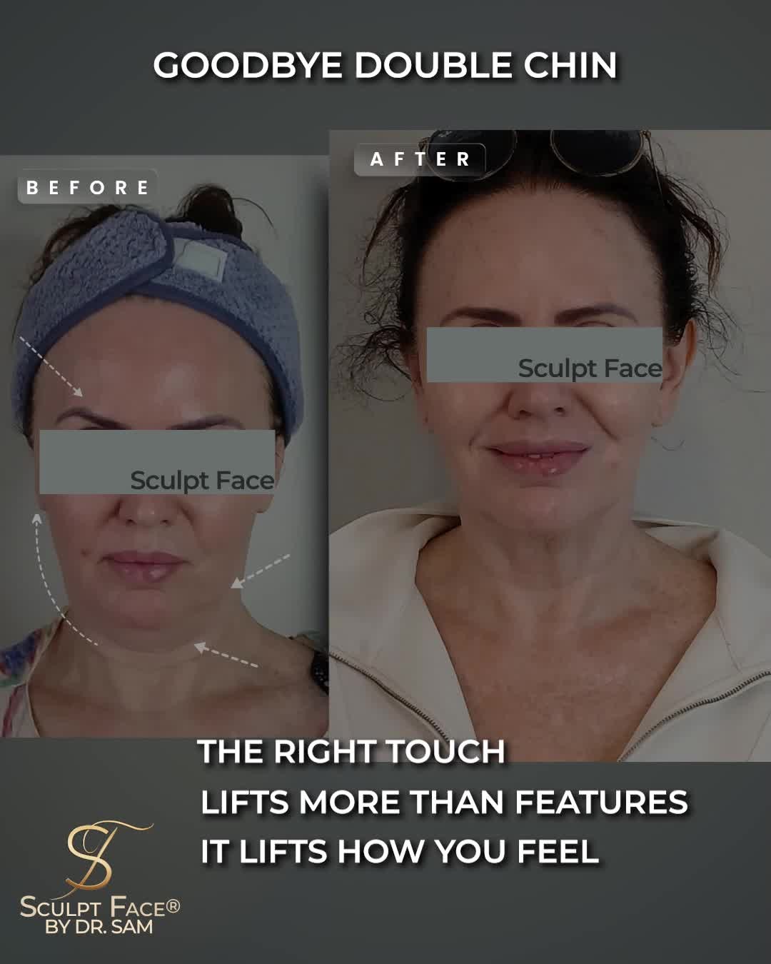 This transformation took only one session.
Using next-generation aesthetics, refined through Dr. Sam’s Sculpt Face Protocol™.
Results:
* Skin complexion brightened and tone more even
* Reduced redness
* Under Eye shadows softened
* Eyebrows rebalanced
* Cheeks lifted
* Jawline sculpted and more defined
* Jowls reduced
* Double chin reduced
* Neck appears elongated
#NoFilter
At Sculpt Face®, treatments are tailored to the natural architecture of your face, addressing your concerns.
The right treatment doesn’t just transform how you look, it can transform how you feel.
It's time to elevate your glow.
Discover the Sculpt Face Protocol™, a surgical approach to non-surgical rejuvenation.
By 𝓓𝓻. 𝓢𝓪𝓶 𝔁
#SculptFace
#SculptFaceProtocol
#EndoliftUK
#endolift
#endoliftlaser
#endolifting
#endolifttreatment
#endoliftingfacial
#NonSurgicalFacelifts
#SkinRejuvenation
#SkinGoals
#GlowFromWithin
#CollagenBoost
#SkinTightening
#SkinTighteningTreatment
#facialrejuvenation
#laserrejuvenation
#nonsurgical
#aesthetictreatments
#liverpoolaestheticsclinic
#manchesteraestheticsclinic
#leedsaestheticsclinic
#sheffieldaestheticsclinic
#greatermanchesteraesthetics
#cheshireaestheticsclinic