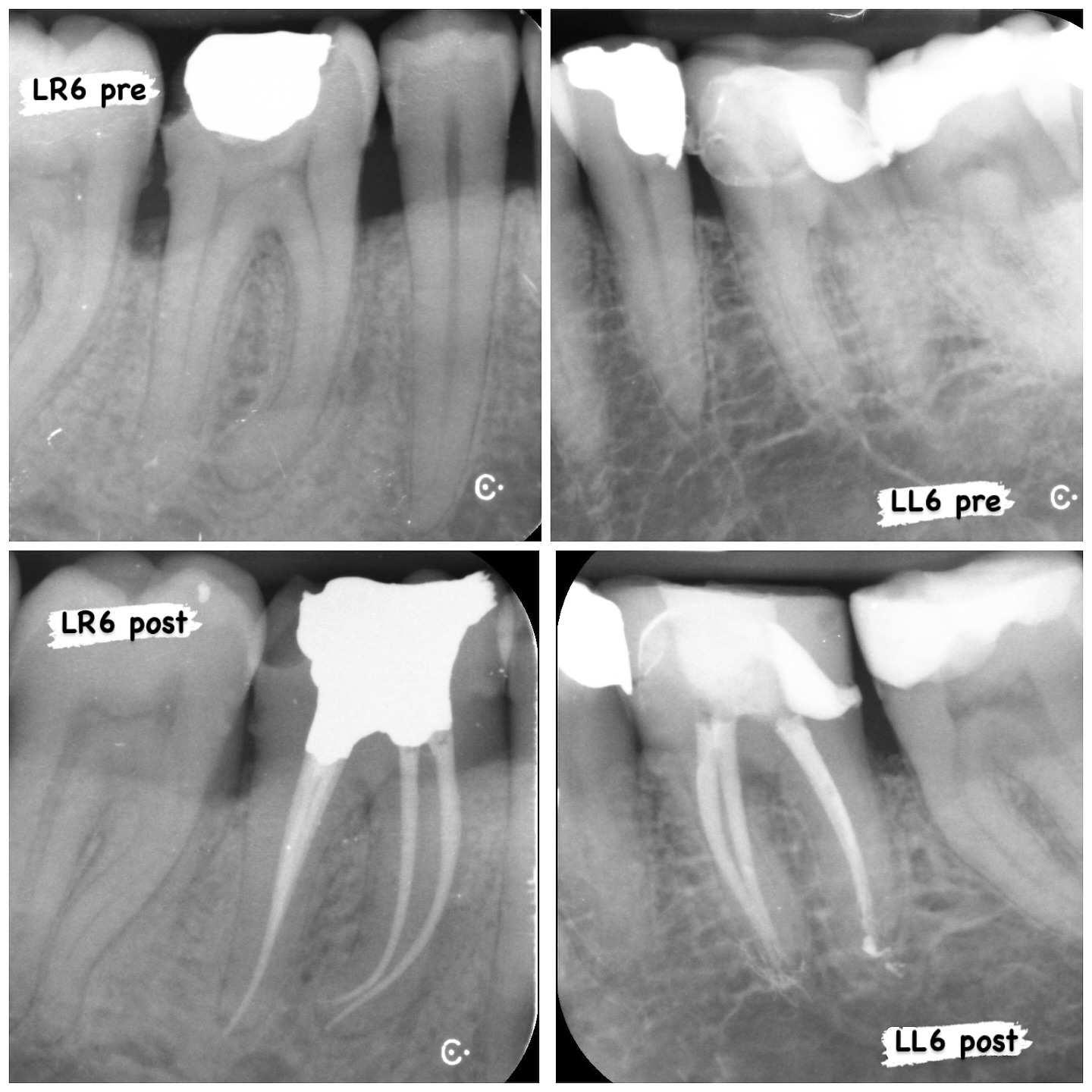 2 referral cases. LR6 SIP/SAP 4 canals 3 POEs. Curvy mesials. 25/04 shapes. LL6 SIP/healthy pa tissues. 3 canals 3 exits. Distal DME. Activated irrigation WVC. #rootcanaltreatment #rootcanaltherapy #rootcanal #endodontic #endodontia #savingteeth #dme #deepmarginelevation #hyflexedm #curvedrootcanals