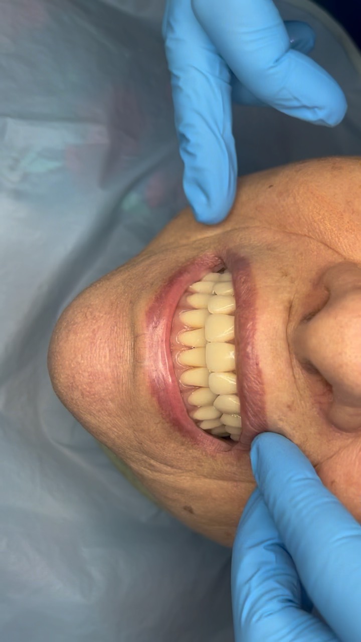 #OdontologiaEstética #Zircônia #zibase #ImplantesDentários #PróteseSobreImplante #Dentista#facetas #lentes #implantes #saudebucal #odontologia #tratamentoodontologico #dente #estetica #anapolis #implantezirconia #odontologiabiológica #odontolgiaintegral #odontologiabiologicaeintegrativa #dentistaanapolis #scannerintraoral