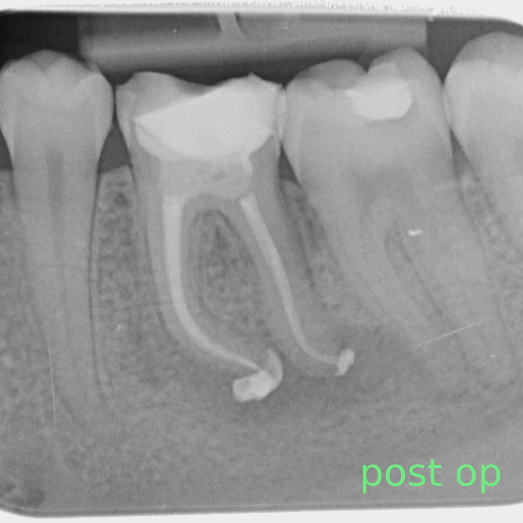 ll6 rct on young patient. reviewed today, healing well after 6m despite the excessive bioceramic sealer puff. i likely over prepared the apical portion of a mesial canal. ll7 stepwise caries removal- radiolucency is of the CaOH base which is still going strong no symptoms and testing vital
#endo #rootcanaltreatment #rct #endodontics #dental #dentistry #teeth #birmingham #rootcanaltherapy