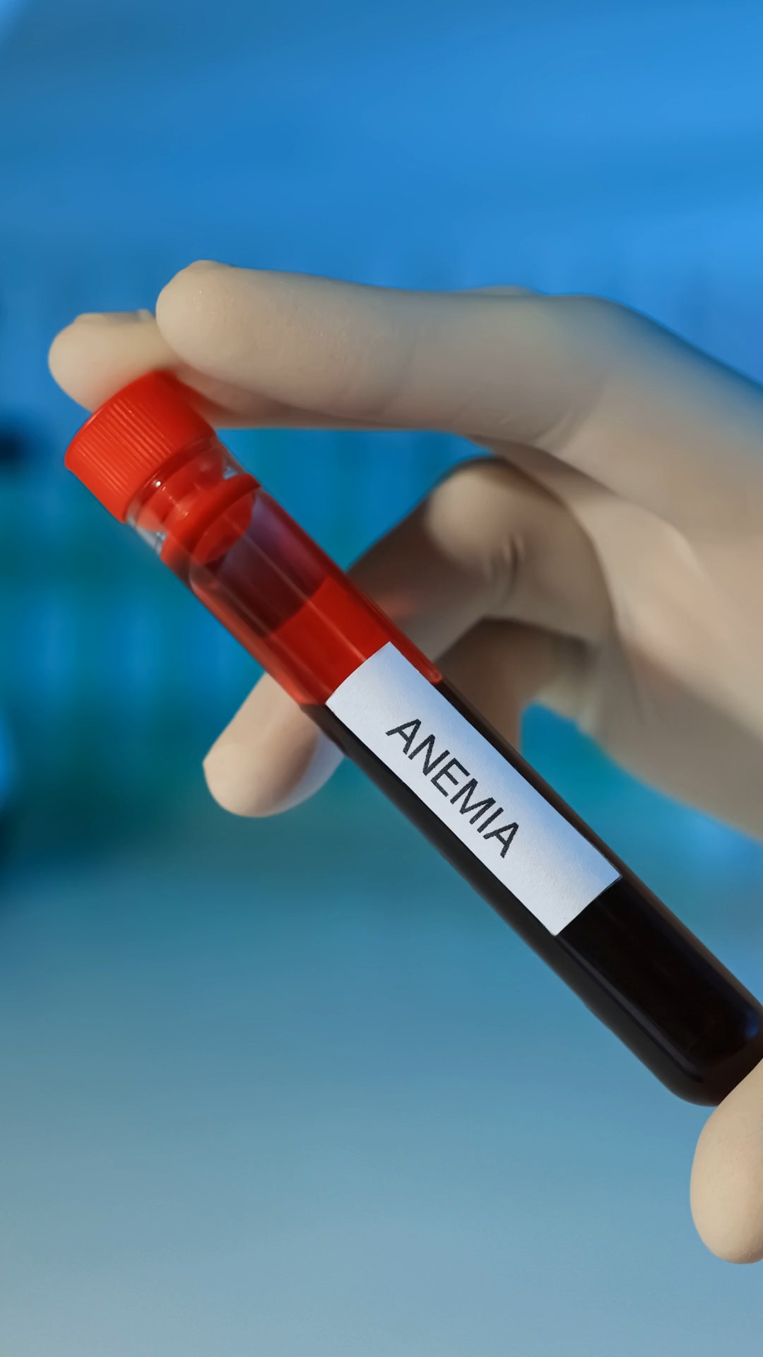 Anemia in Kidney Disease: More Than Just Fatigue
WHAT MOST PEOPLE DON'T KNOW:
Anemia isn't just about feeling tired—in kidney disease, it's a serious condition that shouldn't be ignored.
THE HIDDEN DANGERS:
When you're anemic with kidney disease:
❌ Forces your heart to work harder
❌ Accelerates kidney damage through heart stress
❌ Significantly increases your risk of death
REAL PATIENT STORY:
My patient Jennifer came to me exhausted and breathless. Her hemoglobin was 8.5 g/dL (normal is above 12). After starting treatment, her energy returned and her heart function improved.
WHY THIS HAPPENS:
Healthy kidneys produce erythropoietin, a hormone that signals bone marrow to make red blood cells. As kidney function declines:
Erythropoietin production drops
Fewer red blood cells are made
Anemia develops
THE BOTTOM LINE: Anemia in kidney disease is treatable, but it requires medical attention to prevent serious complications.
📚 References
Anemia in CKD Overview:
KDIGO Clinical Practice Guideline for Anemia in Chronic Kidney Disease (2012). Kidney Int Suppl, 2(4), 279–335. https://kdigo.org/guidelines/anemia-ckd/
Stauffer, M. E., & Fan, T. (2014). Prevalence of anemia in CKD in the United States. PLoS One, 9(1), e84943. https://doi.org/10.1371/journal.pone.0084943
Impact on the Heart and Mortality:
Astor, B. C., et al. (2002). Association of kidney function with anemia: the Third National Health and Nutrition Examination Survey (1988–1994). Arch Intern Med, 162(12), 1401–1408. https://doi.org/10.1001/archinte.162.12.1401
Silverberg, D. S., et al. (2001). The role of correction of anemia in the progression of chronic kidney disease, congestive heart failure, and cardiovascular disease. Clin Nephrol, 55(1), 1–10.
Erythropoietin Production and Decline in CKD:
Jelkmann, W. (2011). Regulation of erythropoietin production. J Physiol, 589(Pt 6), 1251–1258. https://doi.org/10.1113/jph
Medical Disclaimer: This content is for educational purposes only. Always consult your healthcare provider for anemia evaluation and treatment.
#Anemia #KidneyDisease #CKDAnemia #KidneyHealth #Erythropoietin #EvidenceBasedMedicine #Nephrology #HeartHealth #CKDComplications #KidneyAnemia