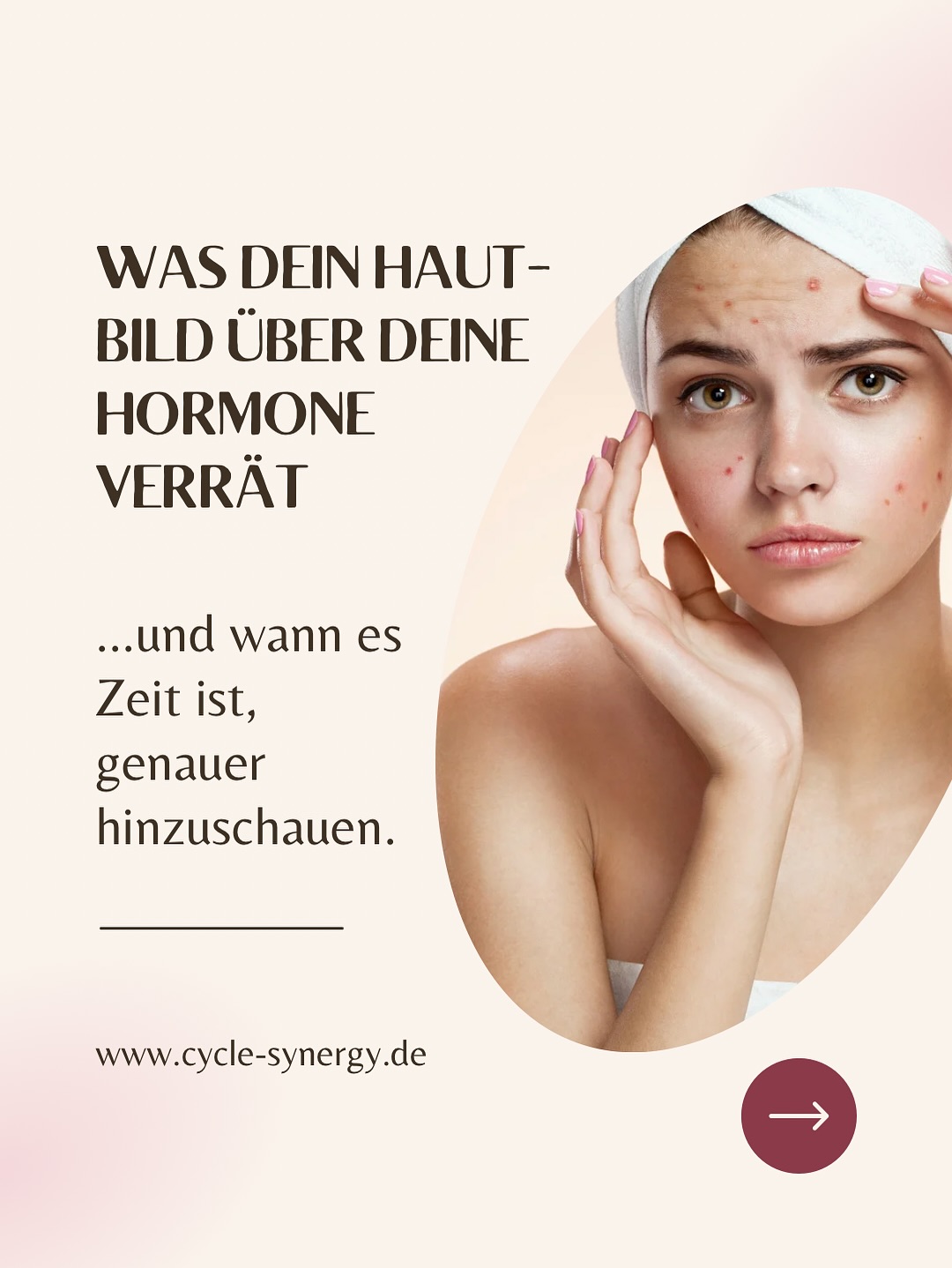 Unreine Haut vor der Periode? Unterlagerungen am Kinn? Zyklische Pickel?
Solche Veränderungen treten bei vielen Frauen auf – und haben häufig hormonelle Ursachen. Ein besseres Verständnis deines Zyklus kann helfen, die Zusammenhänge zu erkennen.
In der ersten Zyklushälfte wirkt das Hormon Östrogen hautfreundlich: Es fördert Kollagen, verbessert die Hautdurchfeuchtung und steigert die Elastizität. Viele Frauen empfinden ihre Haut in dieser Phase als besonders klar.
Nach dem Eisprung steigt das Hormon Progesteron, das entzündungshemmend wirkt und die Hautbarriere unterstützen kann.
Zum Zyklusende hin sinken jedoch sowohl Östrogen als auch Progesteron deutlich ab.
In dieser Phase können Androgene – insbesondere Testosteron und sein aktiveres Umwandlungsprodukt DHT (Dihydrotestosteron) – relativ stärker wirken. Das kann die Talgproduktion anregen und bei entsprechender Veranlagung oder hormoneller Disposition zu Unreinheiten oder entzündlicher Akne führen.
Besonders sichtbar ist das oft bei PCOS, nach dem Absetzen hormoneller Verhütung oder in der Perimenopause.
Doch nicht immer sind die Hormone allein verantwortlich: Auch Ernährung, Mikronährstoffmängel, chronischer Stress oder ein überlasteter Darm können das Hautbild beeinträchtigen.
In meinem neuen Blogartikel erkläre ich die Zusammenhänge noch genauer.
👉 Jetzt lesen: Link in der Bio!
Hat dir der Beitrag gefallen? Dann lass mir gern ein ❤️ da und teile ihn mit einer Freundin, die mit Hautproblemen kämpft.
#hautundhormone #hormonelleakne #zykluswissen #androgene #PCOS #Pilleabsetzen #Frauengesundheit #hautgesundheit