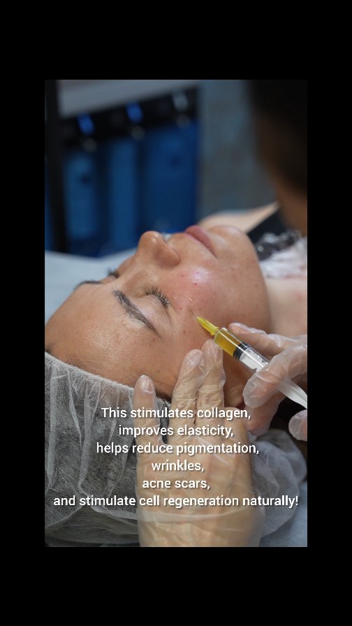 Your blood can turn back the clock for $350⏰💉
No filters. No makeup. Just results from my own plasma doing the magic. 🌿
Done by licensed professionals with years of experience 💉✨
PRP (Platelet-Rich Plasma) is 100% natural and powerful:
🔹 Boosts collagen production
🔹 Improves skin texture and tone
🔹 Fades scars and pigmentation
🔹 Speeds up healing and cellular repair
Want healthy, glowing skin — from the inside out?
Come at LNO Boutique
🔗 Click the link in bio @lno_boutique to schedule your treatment today!
DM me to book your appointment or ask questions!
#PRPFacial
#PRPPlasmaLift
#NaturalRejuvenation
#GlowWithPRP
#PRPSkinTreatment
#PlasmaFacial
#PRPInjections
#CollagenBoost
#SkinRejuvenationDenver
#PRPHighlandsRanch
#CentennialSkincare
#DenverFacialExpert
#HighlandsRanchBeauty
#ParkerColoradoSpa
#LNOcare
#LNOskin
#GlowingSkinColorado
#ColoradoEsthetician
#LicensedSkinExpert
#SkinClinicDenver
#SpaDayColorado
#AntiAgingNaturally
#DenverBeautyPro
#HighlandsRanchEsthetician
#CentennialFacials
#lno_boutique