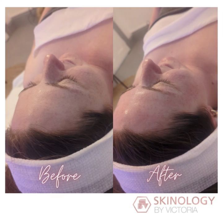 This client tried an advanced bespoke 90 minute skin treatment for the first time, and you can see the amazing glow, which will just keep increasing as the skin cells turnover. This treatment although advanced has little down time and redness 💎
Loving how quick this new device is 🥰
Start your skin journey at www.skinologybyvictoria.com