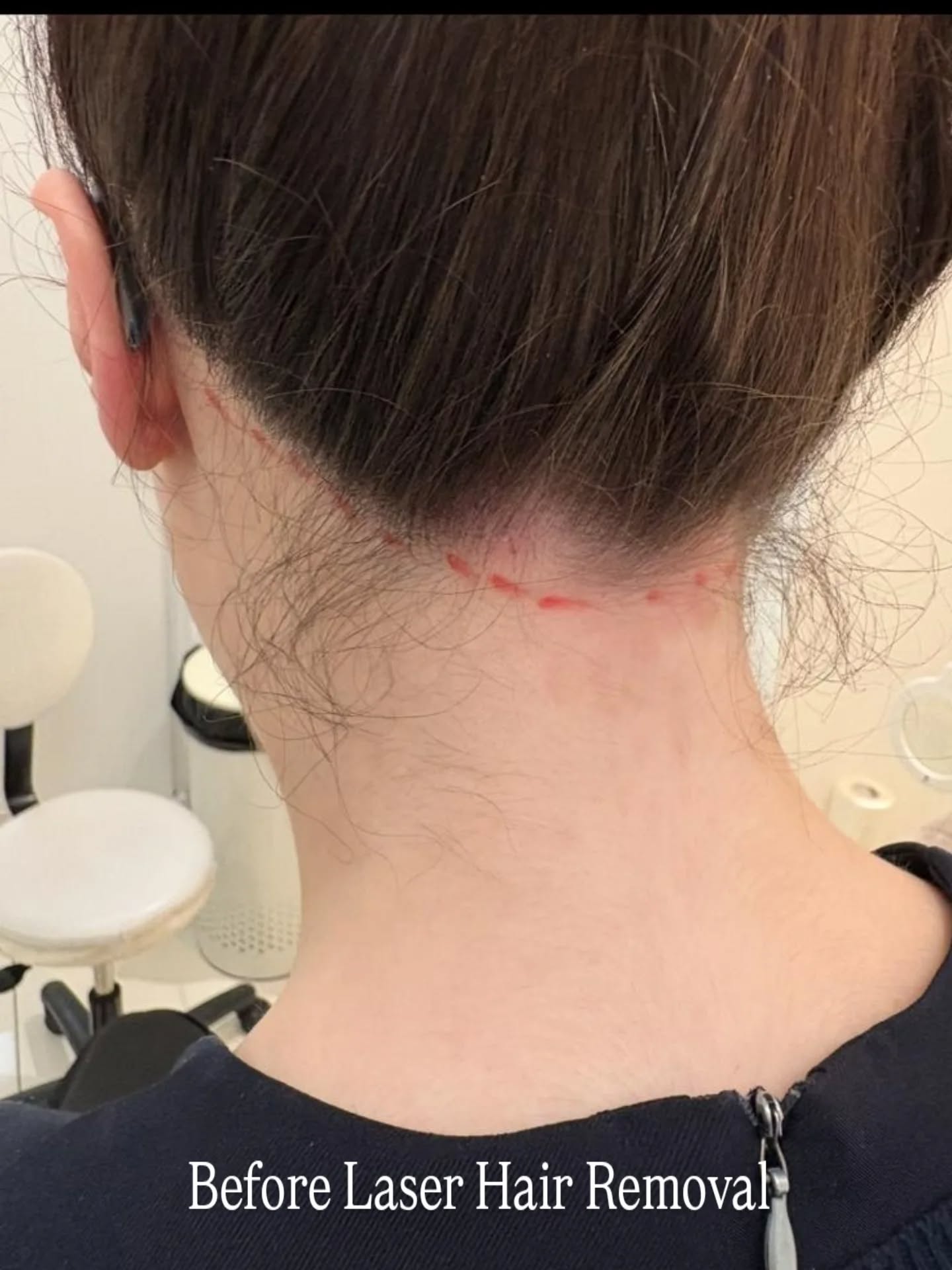 Laser hair removal for the back of the neck is a game-changer for both men and women who want a neat, defined hairline –
no more constant shaving or trimming!
💥 A little redness (erythema) or localised swelling (periocular oedema) is totally normal right after treatment – it usually settles within a few hours.
To help soothe the skin, we recommend:
✅ Avoiding heat (gym, hot showers, saunas) for 24 hours
✅ Applying pure aloe vera to calm the area
🎯 Free consultation & patch test available!
Let’s tailor a plan that works for your skin and hair type.
📩 DM us to book your free consult today!
#LaserHairRemoval #NecklineGoals #SmoothSkin #HairFree #LaserTreatment #MensGrooming #WomensHaircare #AloeVeraCare #SkinClinic #FreeConsultation