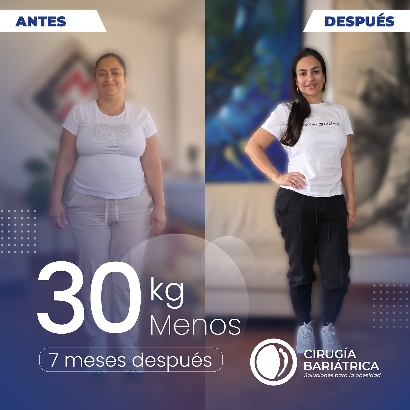✨ 30 kilos menos en solo 7 meses ✨
Gracias a la cirugía bariátrica realizada por el Dr. Bolaños y su equipo, esta paciente transformó su vida con el respaldo de una tecnología de punta y un acompañamiento médico excepcional.
Hoy, su bienestar y confianza hablan por sí solos. 💪💙
✨ 66 pounds lost in just 7 months ✨
Thanks to the bariatric surgery performed by Dr. Bolaños and his team — along with cutting-edge technology — this patient has completely transformed her life.
Her health and confidence speak louder than words. 💪💙
#bariátrica #bariatrica #bariatric #healthy #healthiswealth #surgery #weightlosssurgery #beforeandafter #antesydespues #healthyliving #healthychoices