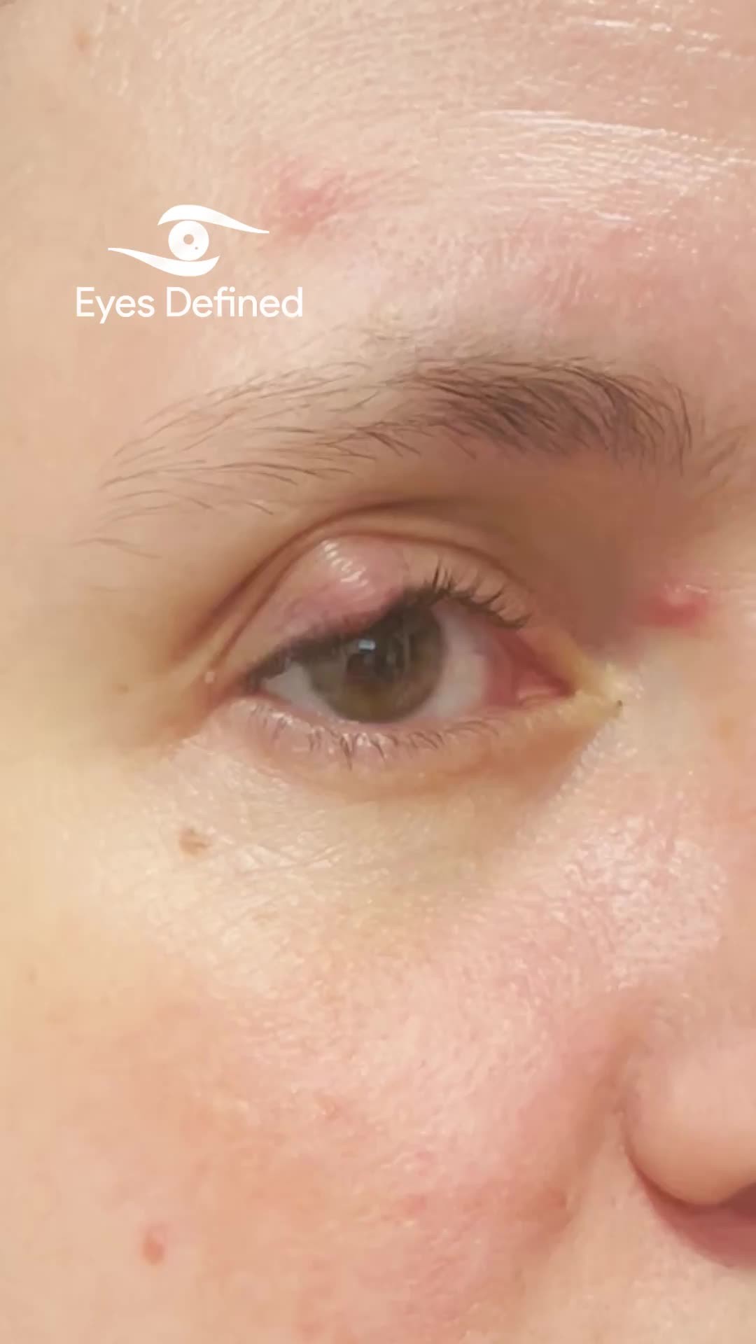 This patient presented with a significant chalazion affecting the right upper eyelid. Here's the result just 2 weeks post-surgery β most of the swelling has already resolved, and the remaining fullness will continue to improve in the coming weeks.
Swipe to see the transformation and healing progress.
Early intervention and expert care make all the difference.
π Performed by an oculoplastic surgeon in London, UK
#Chalazion #ChalazionSurgery #Oculoplastics #EyelidSurgery #EyelidHealth #LondonSurgeon #OculoplasticSurgeon #Blepharoplasty #EyeCare #ChalazionRemoval #EyelidLump #HealingProgress #FacialAesthetics #LondonOculoplastics #Ophthalmology #BeforeAndAfter