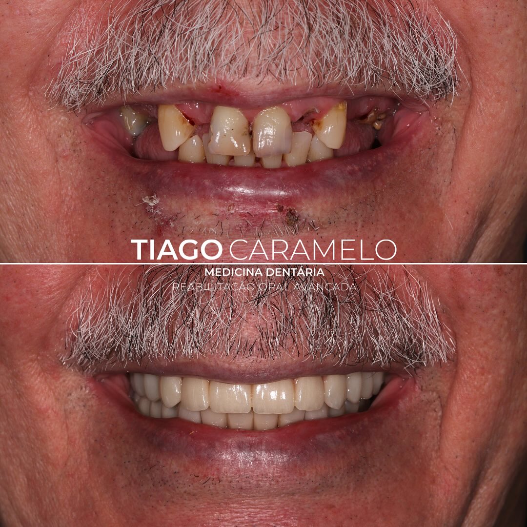 Este paciente chegou à clínica com um sorriso profundamente comprometido: os poucos dentes superiores estavam em estado crítico, os inferiores desgastados, com cáries visíveis e vários dentes posteriores em falta. A funcionalidade estava comprometida e a autoestima, igualmente afetada.
Este foi um daqueles casos em que sabíamos, desde o primeiro momento, que o objetivo ia muito além da estética — tratava-se de devolver qualidade de vida.
Avançámos com uma reabilitação total superior sobre implantes com recurso à técnica All-on-4 finalizada com uma prótese cerâmica, que nos permitiu devolver harmonia e naturalidade. Nos dentes inferiores, preservámos os dentes existentes com recurso a facetas e recorremos a implantes e coroas nas zonas posteriores.
O resultado está à vista: um sorriso renovado, funcional e natural, que representa não só uma transformação oral, mas também emocional.
Trabalho laboratorial realizado por @daniela_cardoso7
Trabalho cirúrgico realizado por @dra.anaferro
—————————————————————————————
This patient came to the clinic with a severely compromised smile: the few remaining upper teeth were in critical condition, the lower teeth were worn down, visibly decayed, and several posterior teeth were missing. Functionality was impaired, and so was self-esteem.
This was one of those cases where we knew from the very beginning that our goal went far beyond aesthetics — it was about restoring quality of life.
We carried out a full upper rehabilitation on implants using the All-on-4 technique, finished with a ceramic prosthesis, which allowed us to restore harmony and a natural appearance. On the lower arch, we preserved the existing teeth with veneers and placed implants and crowns in the posterior regions.
The result speaks for itself: a renewed, functional, and natural smile — representing not just an oral transformation, but an emotional one as well.
Lab work by @daniela_cardoso7
Surgical work by @dra.anaferro
#dentalimplants #allonfour #veneer #smiles