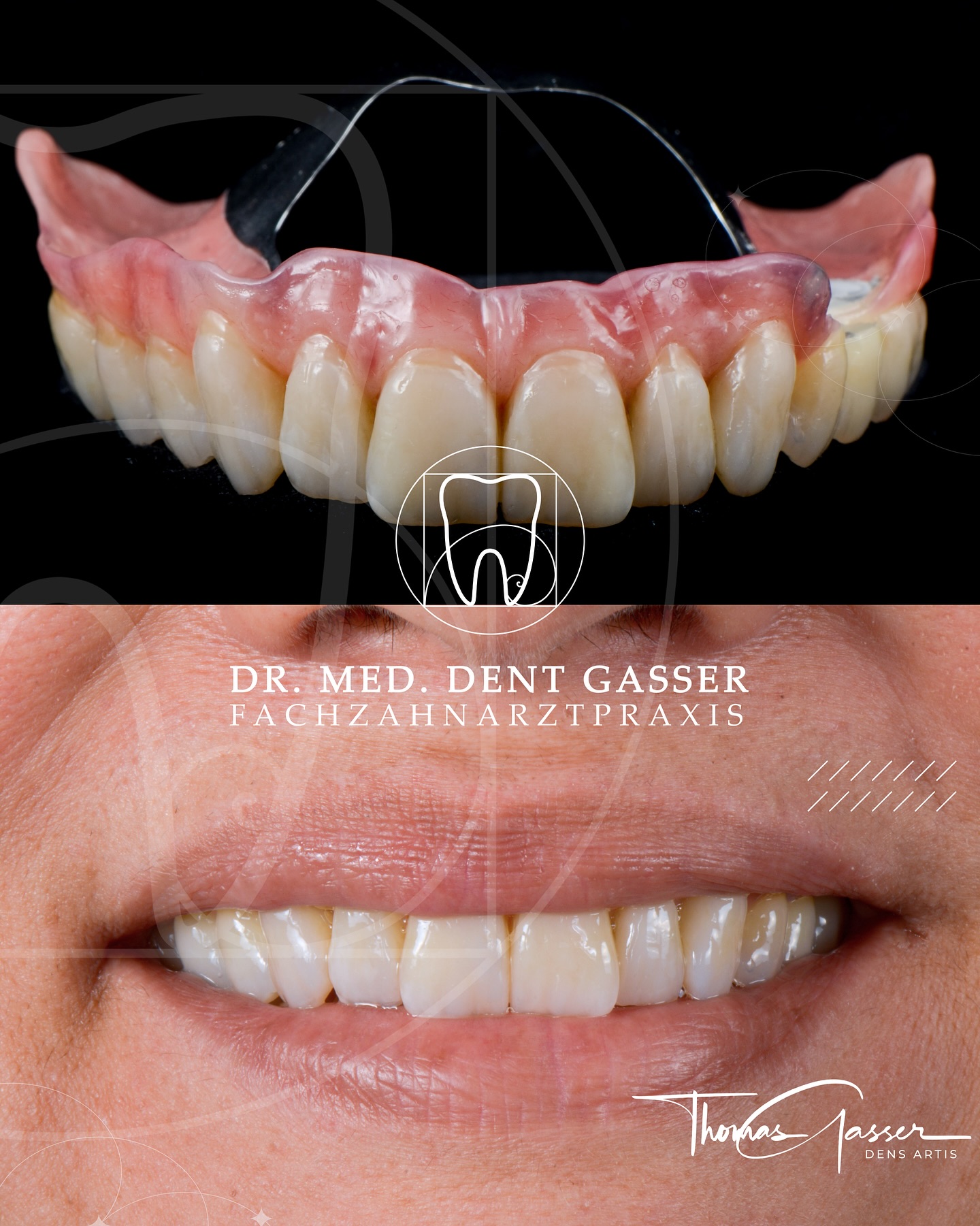 🦷 Mehr Komfort, mehr Freiheit – dank Hybridprothese
Bei starkem Zahnverlust geht es nicht nur um Ästhetik, sondern auch um sicheres Kauen, klares Sprechen und ein unbeschwertes Lächeln.
Unsere Hybridprothesen verbinden die Vorteile festsitzender und herausnehmbarer Versorgungen – für maximalen Halt und Tragekomfort.
➡️ Ziel ist es, eine leichte, gaumenfreie Konstruktion zu schaffen, die stabil sitzt und zugleich angenehm zu tragen ist.
➡️ Dank präzise geplanter Implantate und moderner Verbindungselemente hält die Prothese sicher – auch ohne großflächige Ausdehnung.
💡 Was eine Hybridprothese für Sie bedeutet:
✔️ Fester Sitz ohne Druckstellen
✔️ Keine Gaumenbedeckung – mehr Geschmack und Komfort
✔️ Sicheres Kauen und Sprechen im Alltag
✔️ Ästhetische, natürliche Zahnstellung und Zahnform
✔️ Einfache Reinigung bei hoher Hygienefreundlichkeit
⚠️ Jede Hybridprothese wird individuell geplant – Anzahl und Position der Implantate, Verbindungselemente und Design sind auf Ihre Situation abgestimmt.
Eine gut gemachte Hybridprothese ist mehr als Zahnersatz – sie ist ein Stück Lebensqualität. ✨
📍 Fachzahnarztpraxis Dr. Thomas Gasser
Greifengasse 1, 4058 Basel
📞 +41 61 681 00 10
📧 fachzahnarztpraxis_basel@sso-hin.ch
🌐 www.zahnarztgasser.ch
#Hybridprothese #Implantatprothese #Zahnersatz #ÄsthetischeZahnmedizin #ZahnarztBasel #Implantologie #FesterSitz #Gaumenfrei #Prothetik #DrThomasGasser #Basel