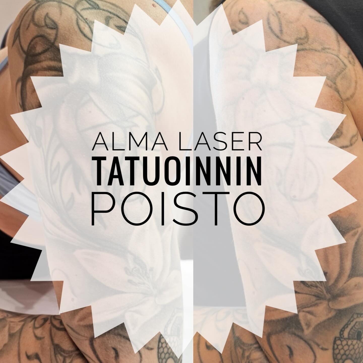Alma laserin Q-Switched Nd:Yag -tekniikalla voidaan poistaa tatuointiväriä tehokkaasti ja turvallisesti.
Lasersäde hajottaa ihossa olevaa mustetta ja elimistö poistaa pigmenttihiukkaset aineenvaihdunnan mukana.
Hoitokertojen määrää riippuu musteen määrästä ja tatuoinnin syvyydestä.
Hoitokertojen välillä on hyvä antaa ihon palautua 2-3 kuukautta ja kotihoito-ohjeita on hyvä noudattaa parhaan hoitotuloksen saamiseksi.
Voit lähettää kuvan hoitoalueestasi yksityisviestillä tai sähköpostilla (info@kosmetologipirita.fi) tai varata maksuttoman konsultaation.
Kuvan hoitoalue on laseroitu kaksi kertaa ja hoitotulos on vaalentunut jo huomattavasti. ✨
#tatuoinninpoisto
#tattooremoval