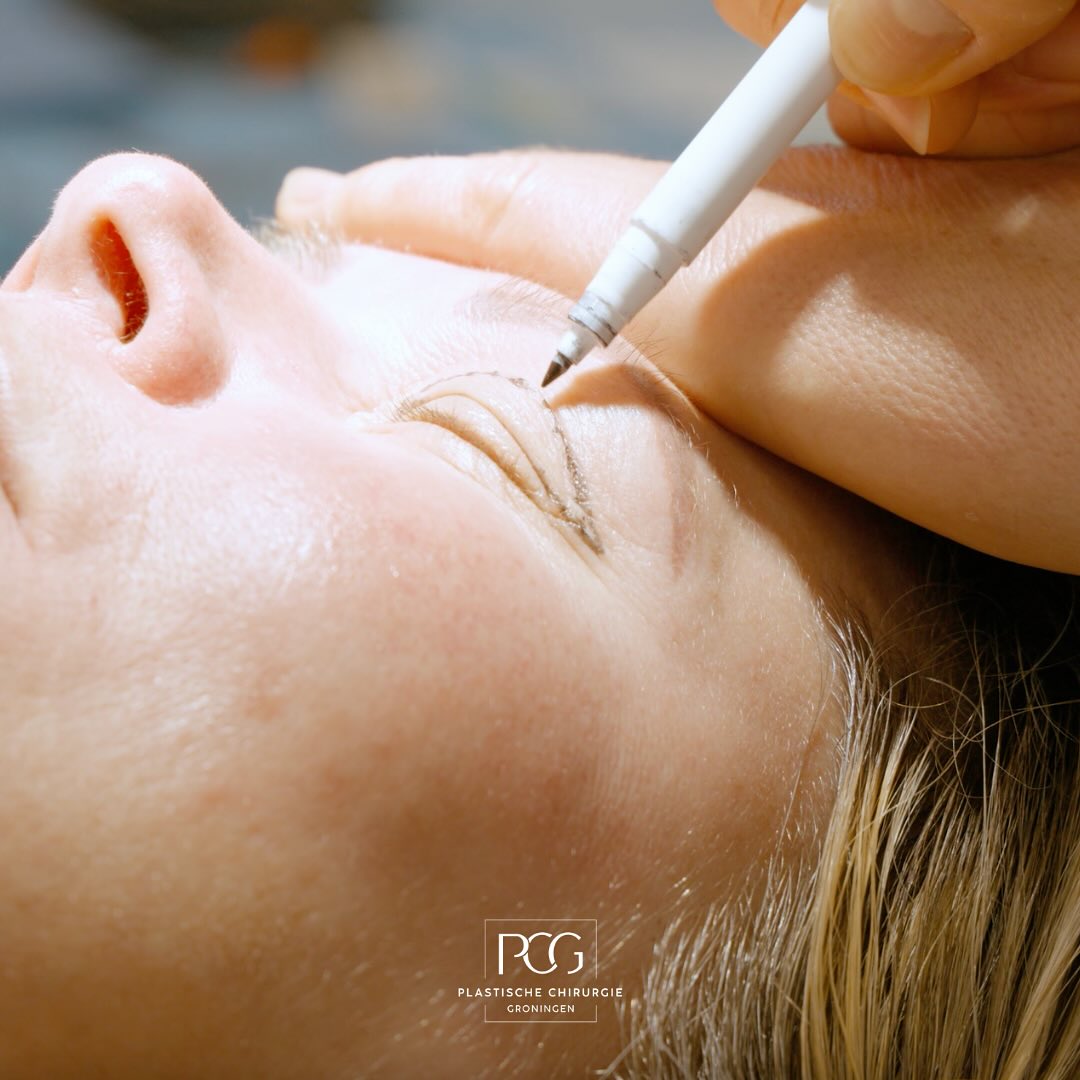Het komt vaak voor dat de huid en spieren rond de ogen verslappen. Dit hoeft niet altijd het gevolg te zijn van het ouder worden. Uw gezichtsuitdrukking komt dan niet overeen met hoe u zich voelt. Door middel van een (boven)ooglidcorrectie lossen onze ervaren plastisch chirurgen dit voor u op!
Wilt u meer informatie betreft de mogelijkheden voor een ooglidcorrectie? Neem dan snel contact met ons op!
📞: 050 - 211 04 96
💌: info@pcgroningen.nl