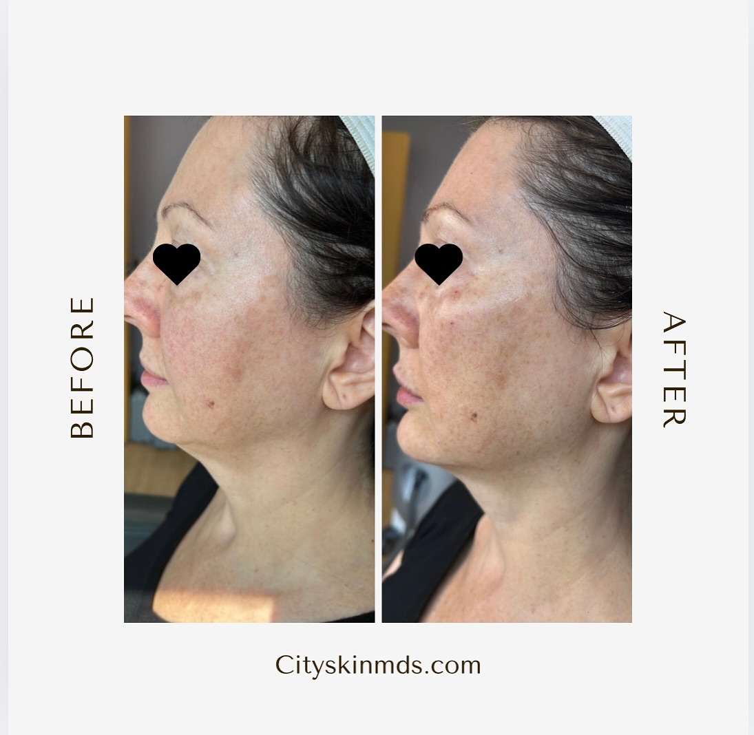 ✨ Face Balancing ✨
It’s not about changing your features — it’s about enhancing your natural harmony.
Small, precise adjustments for a fresher, more balanced you. 💛
📍 9140 Westview Rd, Suite 133
📅 Sun–Tue | Book now
Cityskinmds.com
#FaceBalancing #NaturalResults #EnhanceYourBeauty #cityskinmds #smallbusinessowners #supportsmallbusiness
✨ Armonización Facial ✨
No se trata de cambiar tus rasgos, sino de realzar tu armonía natural.
Pequeños y precisos ajustes para una versión más fresca y equilibrada de ti. 💛
📍 9140 Westview Rd, Suite 133
📅 Dom–Mar | Reserva ahora
Cityskinmds.com
#ArmonizaciónFacial #ResultadosNaturales #ResaltaTuBelleza #negociopequeño #suportanegocioslocais #cityskinmds