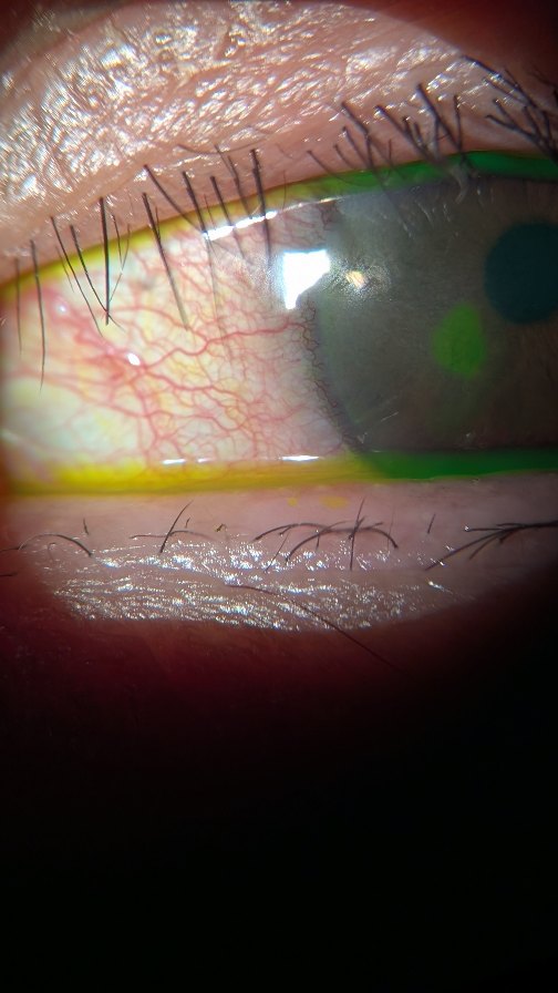 "It’s been an eye-cellent summer 😎☀️ Between the fascinating cases and the fabulously weird moments, optometry kept me on my toes (and my patients in focus 👀).
Here’s a little b-roll tease… full stories? That’s for another day 😉📸"
#EyeCellent #OptometryLife #EyeDoc #EyeCare #SummerVibes #Optometrist #EyeHealth #OptometryFun #PatientCare #LifeOfAnOptometrist #EyeHumor #PhotoDump #Broll #InFocus #EyeSeeYou #Eyetalkdoc #Eyetalk #OptometryTips #OptometryHumor #AskYourEyeDoc #SeeYourOptometrist #EyeLoveIt
#howitsdone #huntrix #demonhunters