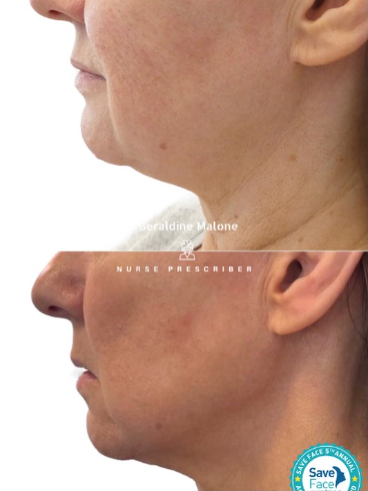Lower face transformation – 8D HIFU
A remarkable lift and contouring achieved mainly through advanced 8D HIFU, with a bespoke combination of treatments tailored for this client.
8D HIFU works deep beneath the skin to stimulate collagen production, tighten, and redefine the jawline — all without surgery or downtime.
Results: Gradual improvement over 12 weeks, lasting 12–18 months.
Recovery: Minimal to none.
-All treatments carried out by Nurse Prescriber Geraldine Malone in a Save Face Registered Clinic
Contact Us:
📍CV6 1EB
☎️ 024 7792 1812
📧geraldinemaloneaesthetics@outlook.com