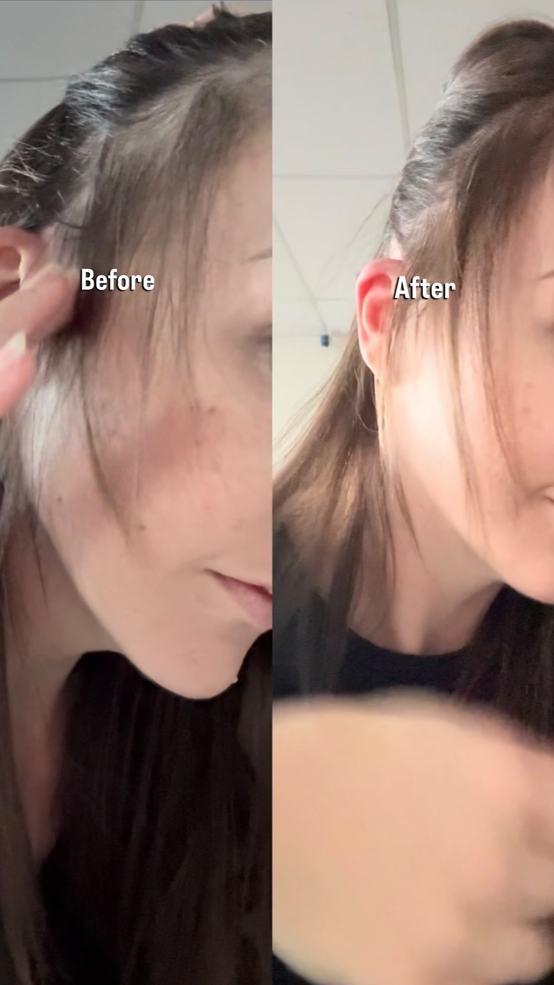 👀 Wait until you see the difference…
My hair loss started after having my second baby. It grew back, but it was finer than before and stuck at the “whispy baby hair” stage for 6 months straight.
After just 6 weeks on the Calecim Hair Growth Treatment, my hair is finally thicker, denser, and growing past that stubborn stage.
With a 95% clinical success rate, Calecim works no matter the cause of thinning or loss.
If your hair has been stressing you out, send us a DM - we’d love to help you get results like this too.
#Calecim #thinninghairsolutionsadelaide #hairlosstreatmentadelaide #stemcellhairtreatmentadelaide #StemCellHairTreatment #HairRegrowth #HairLossTreatment #ScalpHealth #HealthyHairStartsHere #Hairlosshelp #adelaidemums #mumsofadelaide #adelaideladies