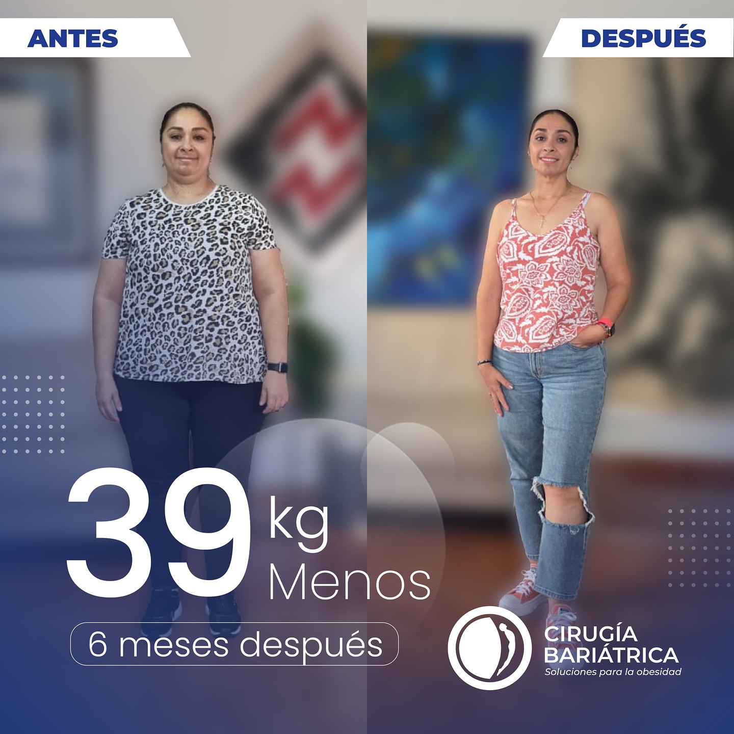 ¡39 kilos menos en solo 6 meses! 💪✨ Gracias a la cirugía bariátrica del Dr. Bolaños y su equipo de trabajo, con profesionales de excelencia y la mejor tecnología, nuestra paciente transformó su vida y recuperó su bienestar. 🌟
86 pounds down in just 6 months! 💪✨ Thanks to the bariatric surgery performed by Dr. Bolaños and his dedicated team, with top professionals and the best technology, our patient has transformed her life and regained her well-being. 🌟
#bariatric #bariatrica #bariatricsurgery #cirugiabariatrica #health #healthiswealth #healthyliving #weightlosssurgery #weightlossjourney #beforeandafter #antesydespues